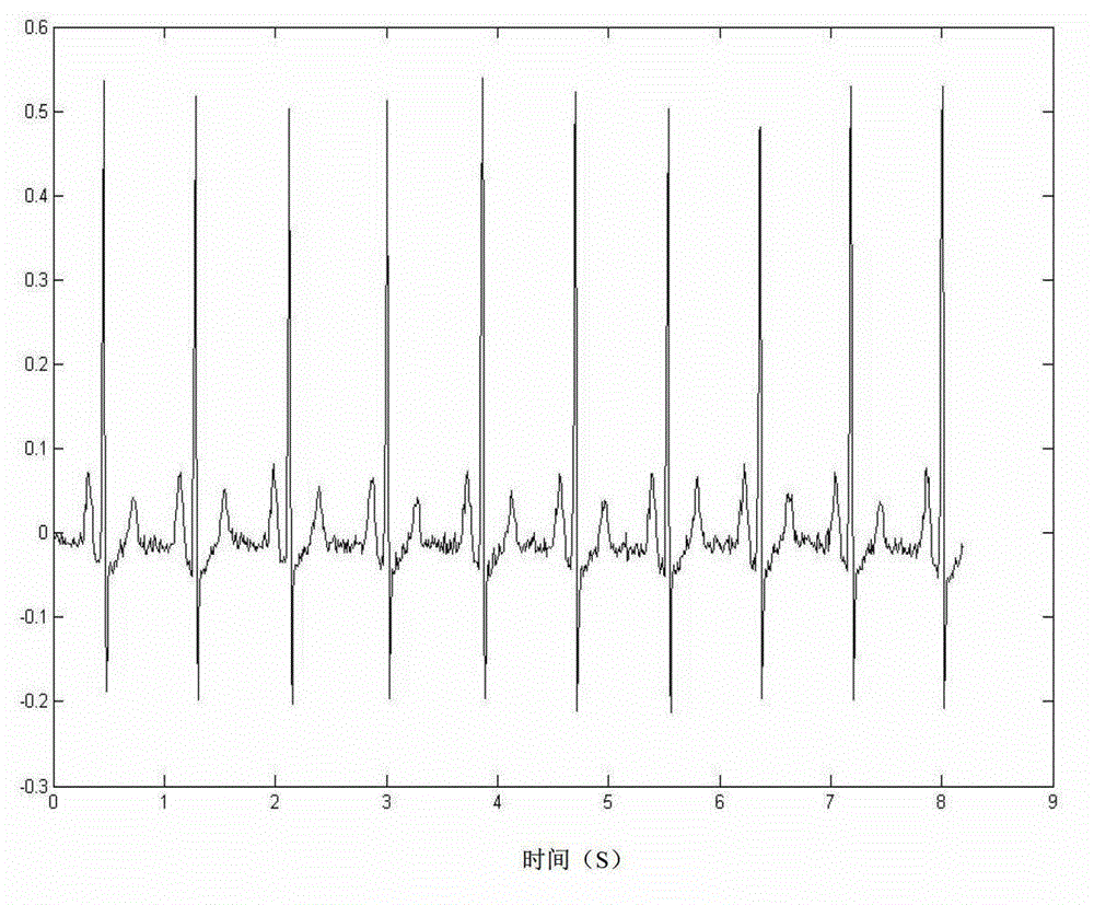 FPGA-based supraventricular tachycardia detection method and system