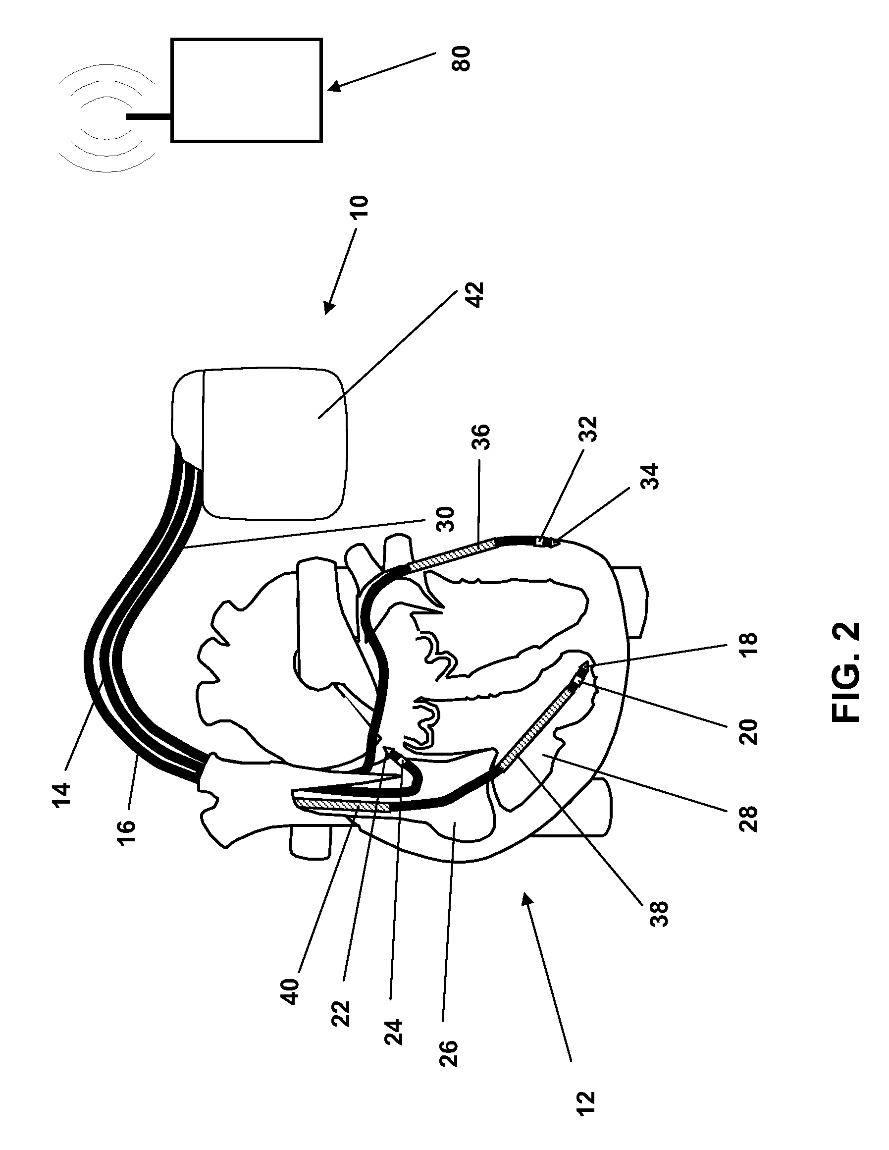 Heart monitoring system