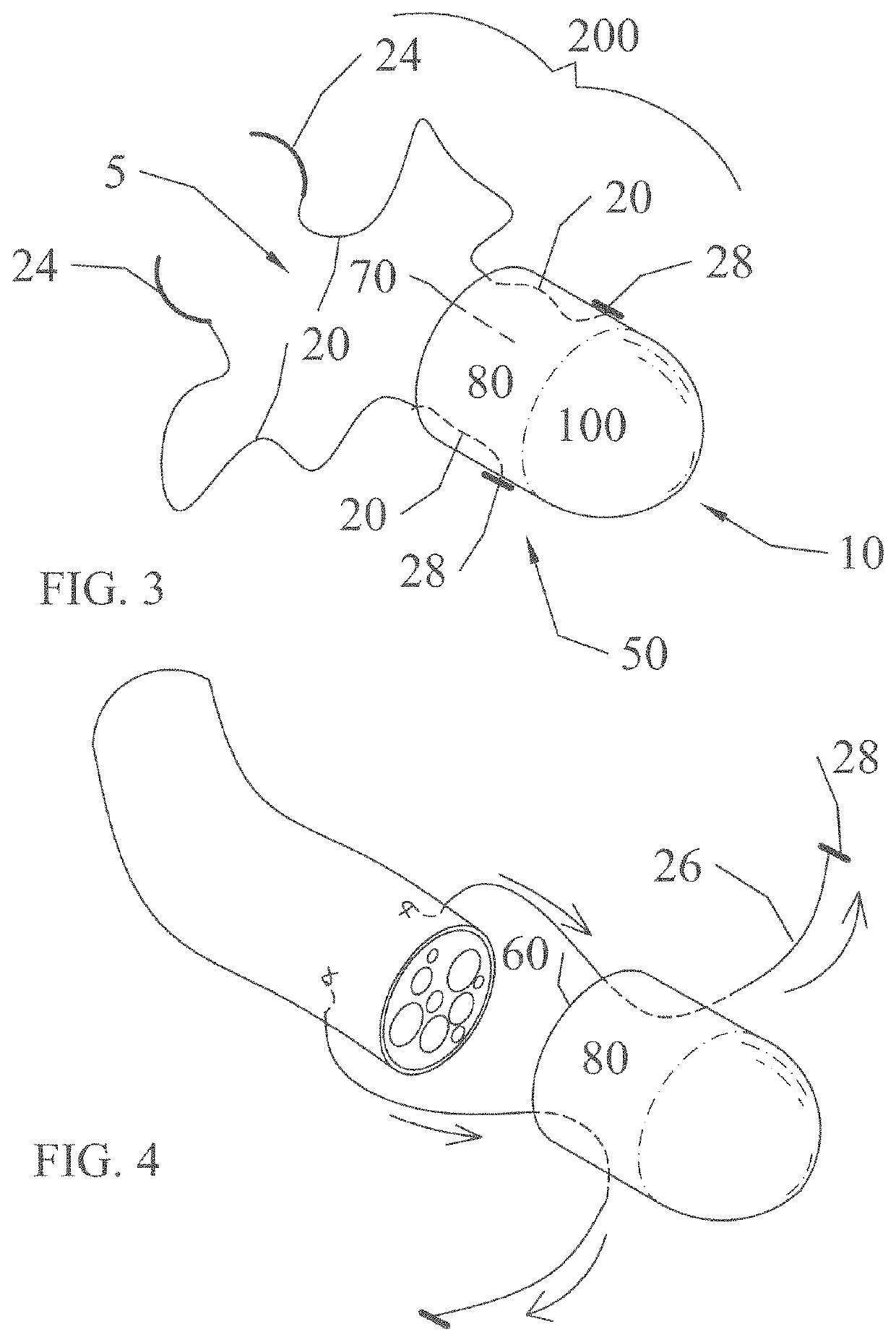 Implant devices with a pre-set pulley system