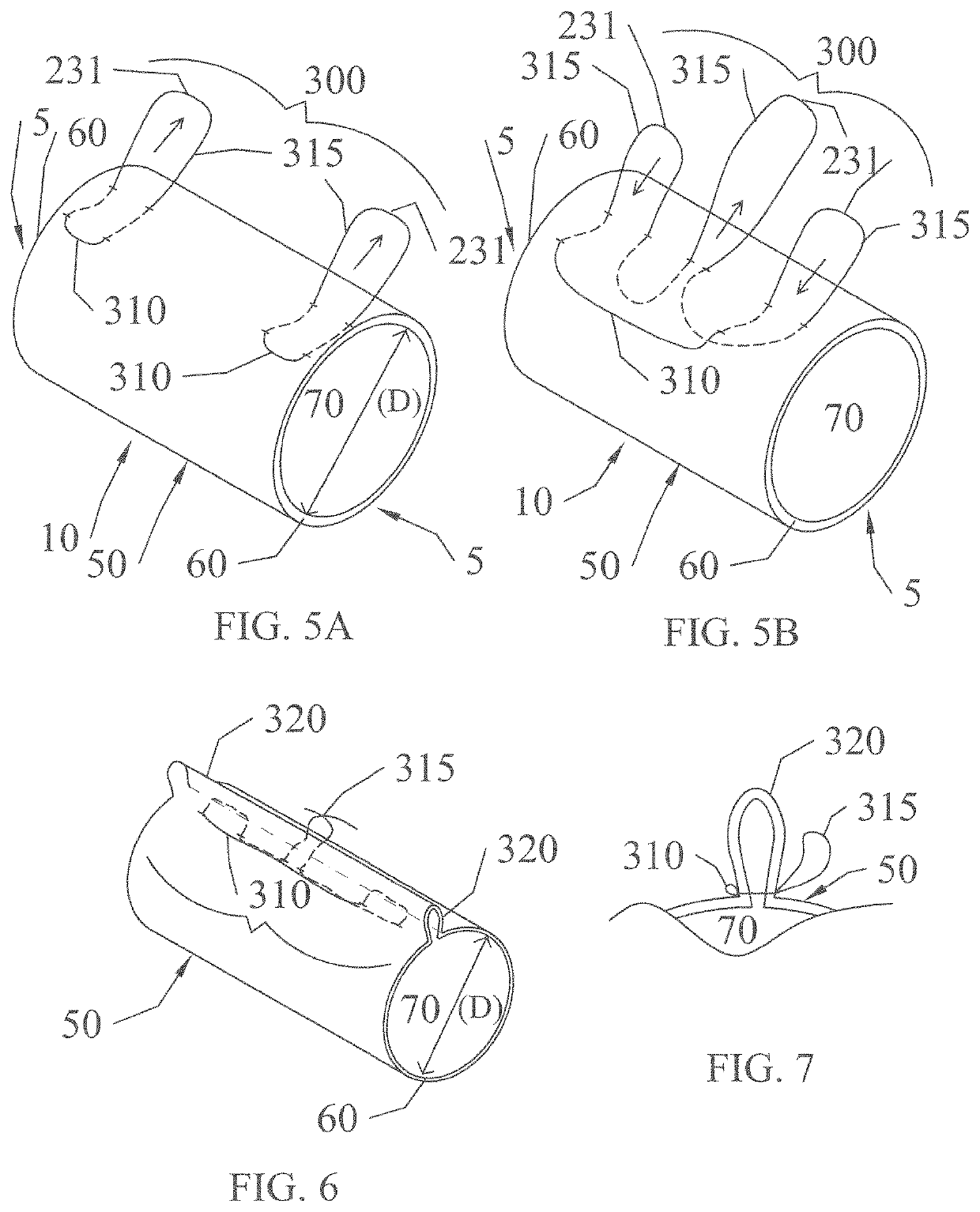 Implant devices with a pre-set pulley system