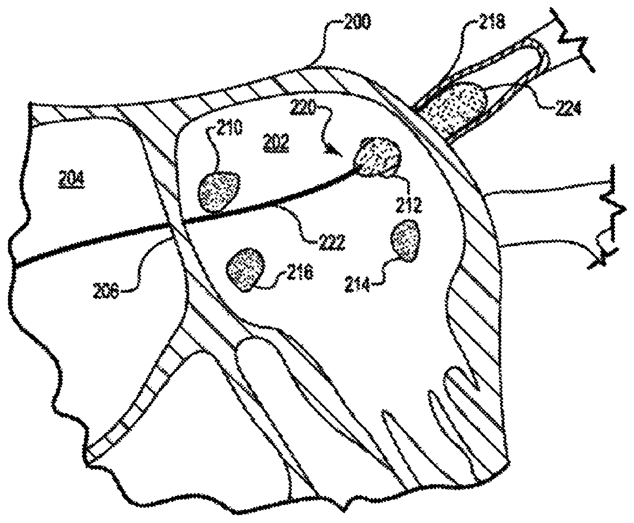 Calcium electroporation delivery apparatus