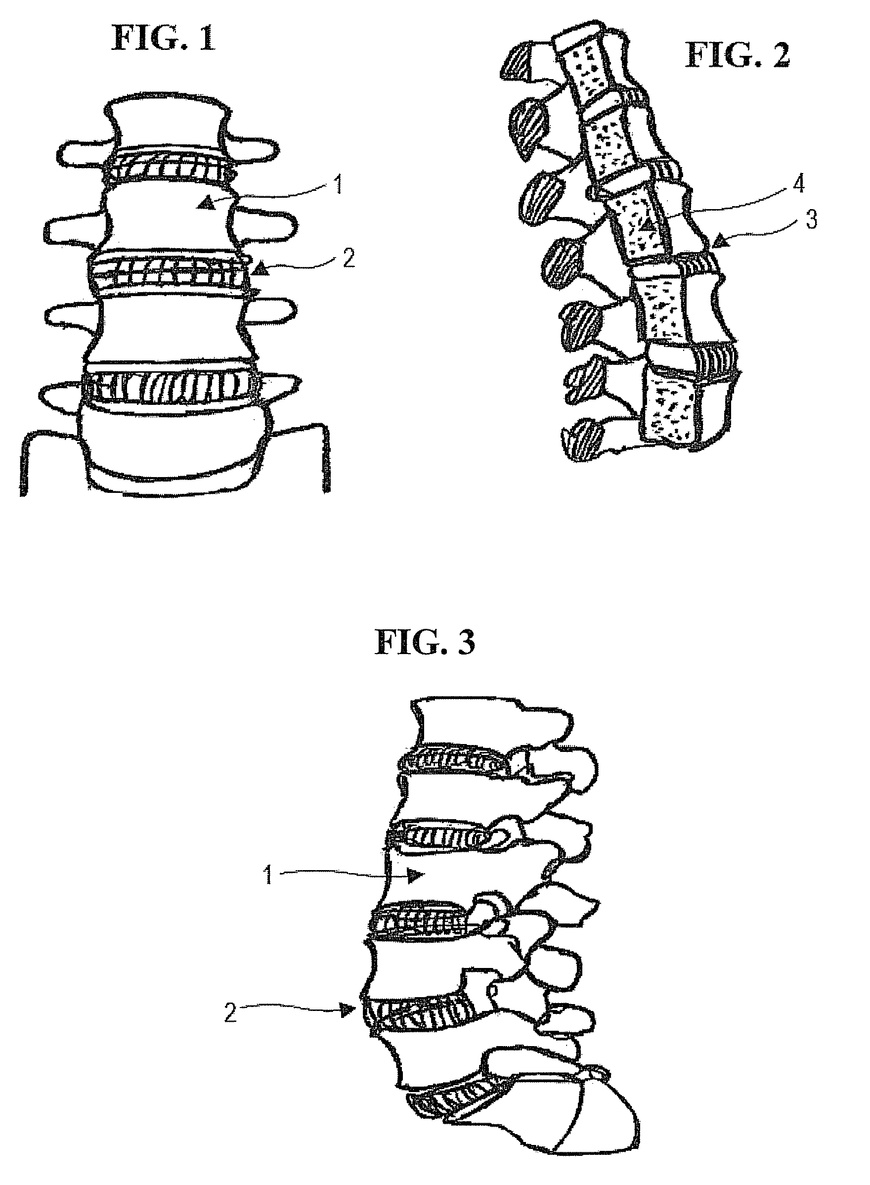 Apparatus for anterior intervertebral spinal fixation and fusion