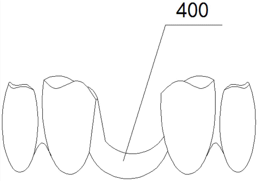 A tooth fixing device and dentures