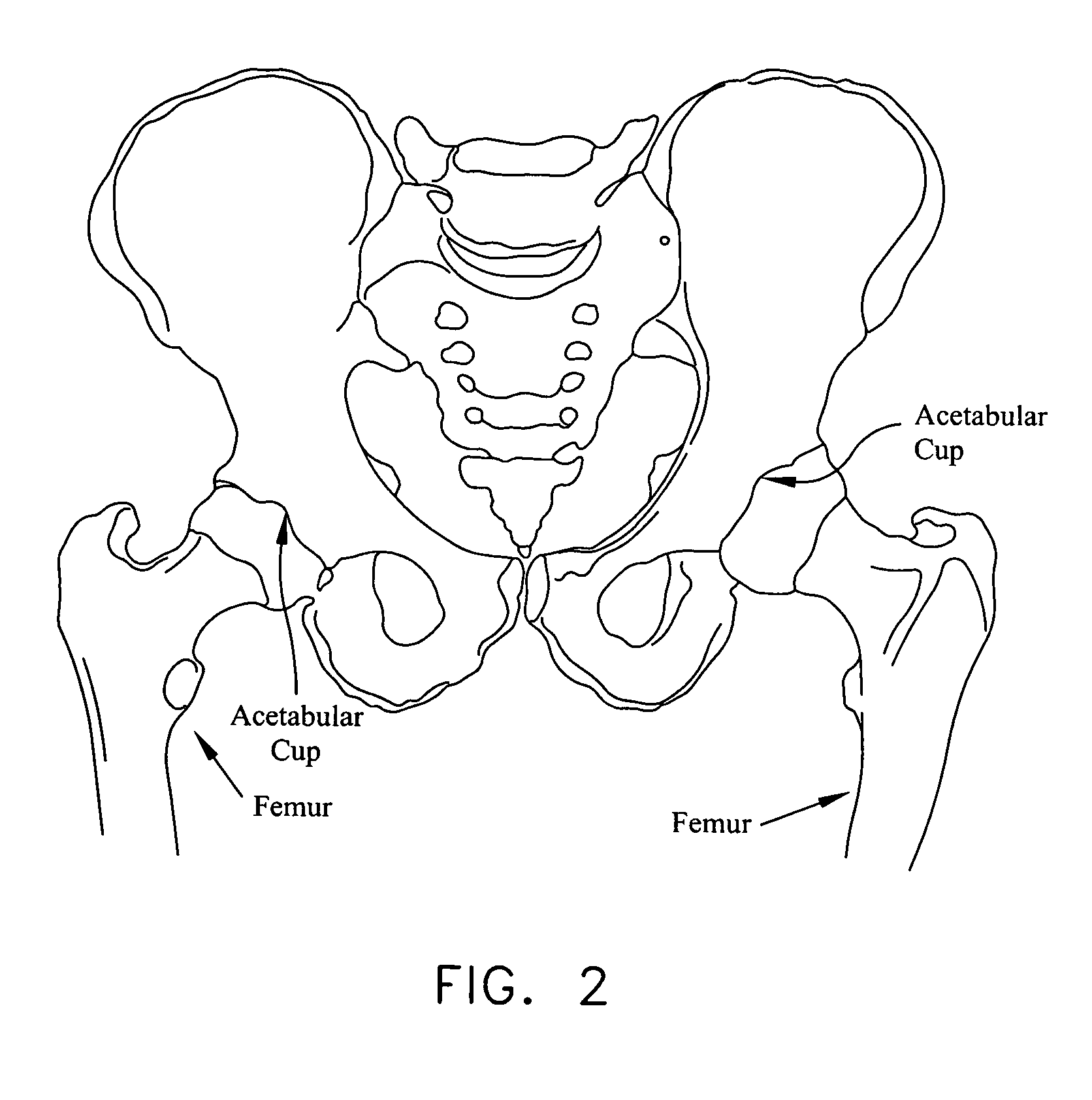 Method and apparatus for re-attaching the labrum of a hip joint