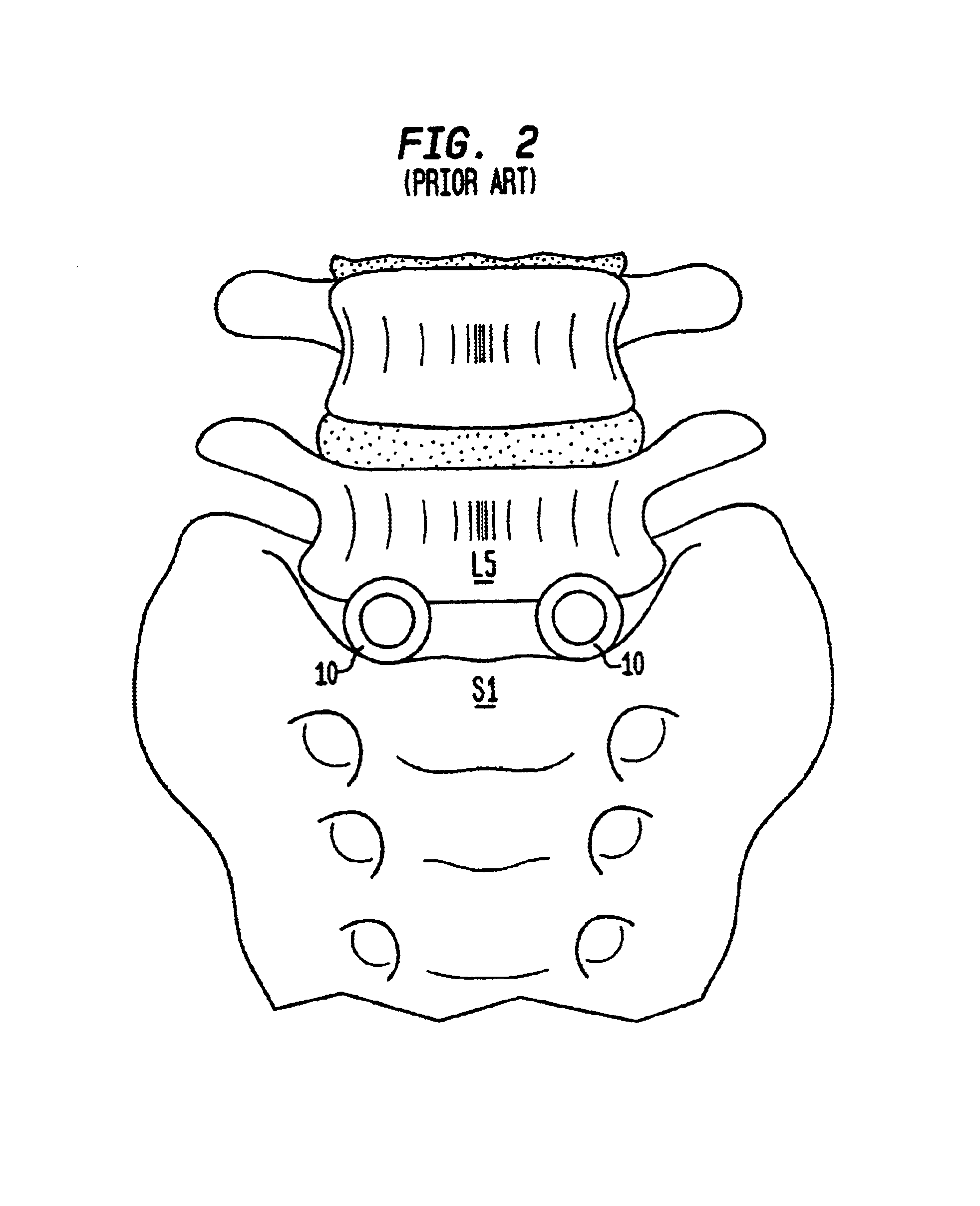 Intervertebral spacer device having a domed arch shaped spring