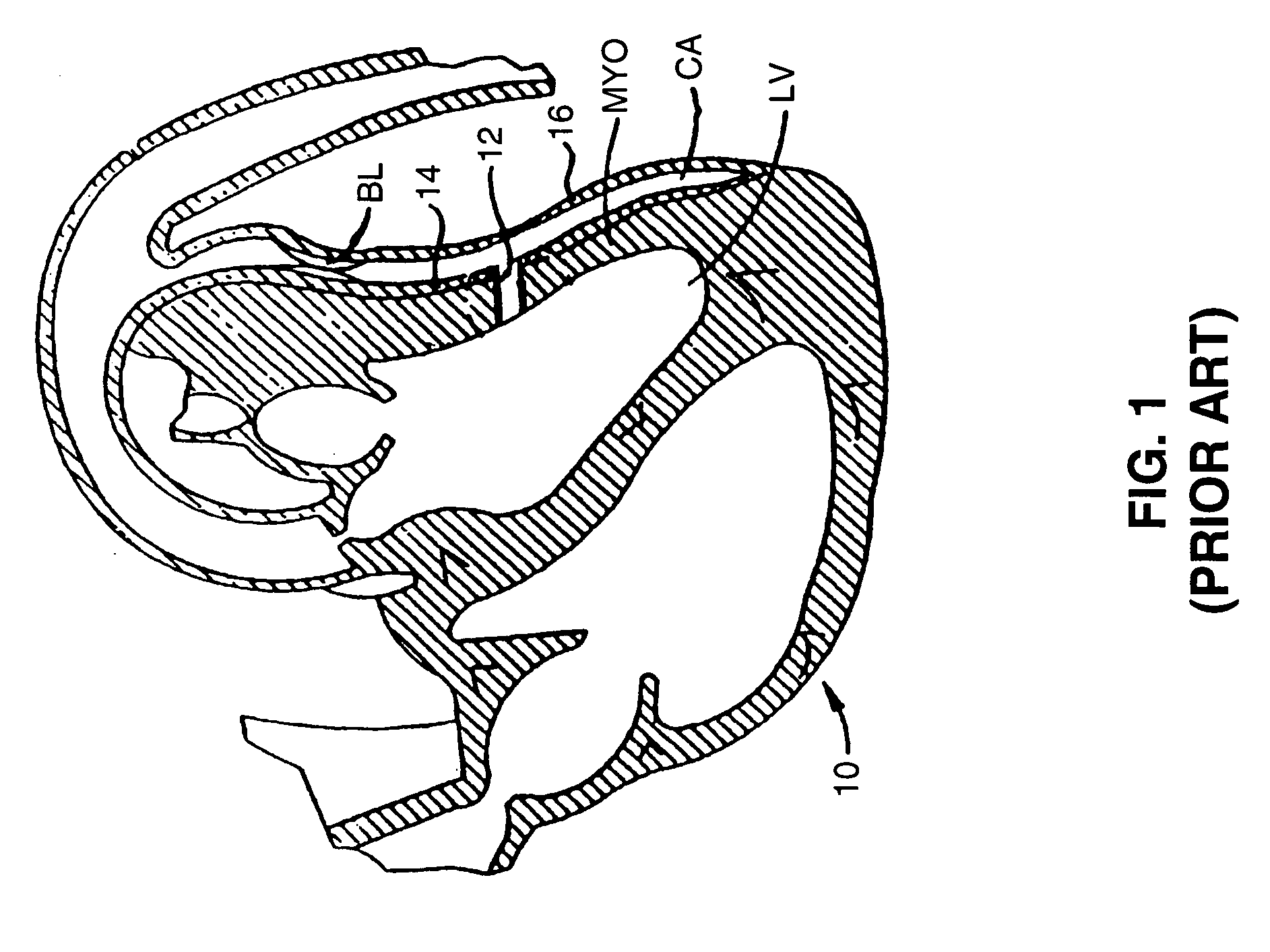 Hinged tissue implant and related methods and devices for delivering such an implant