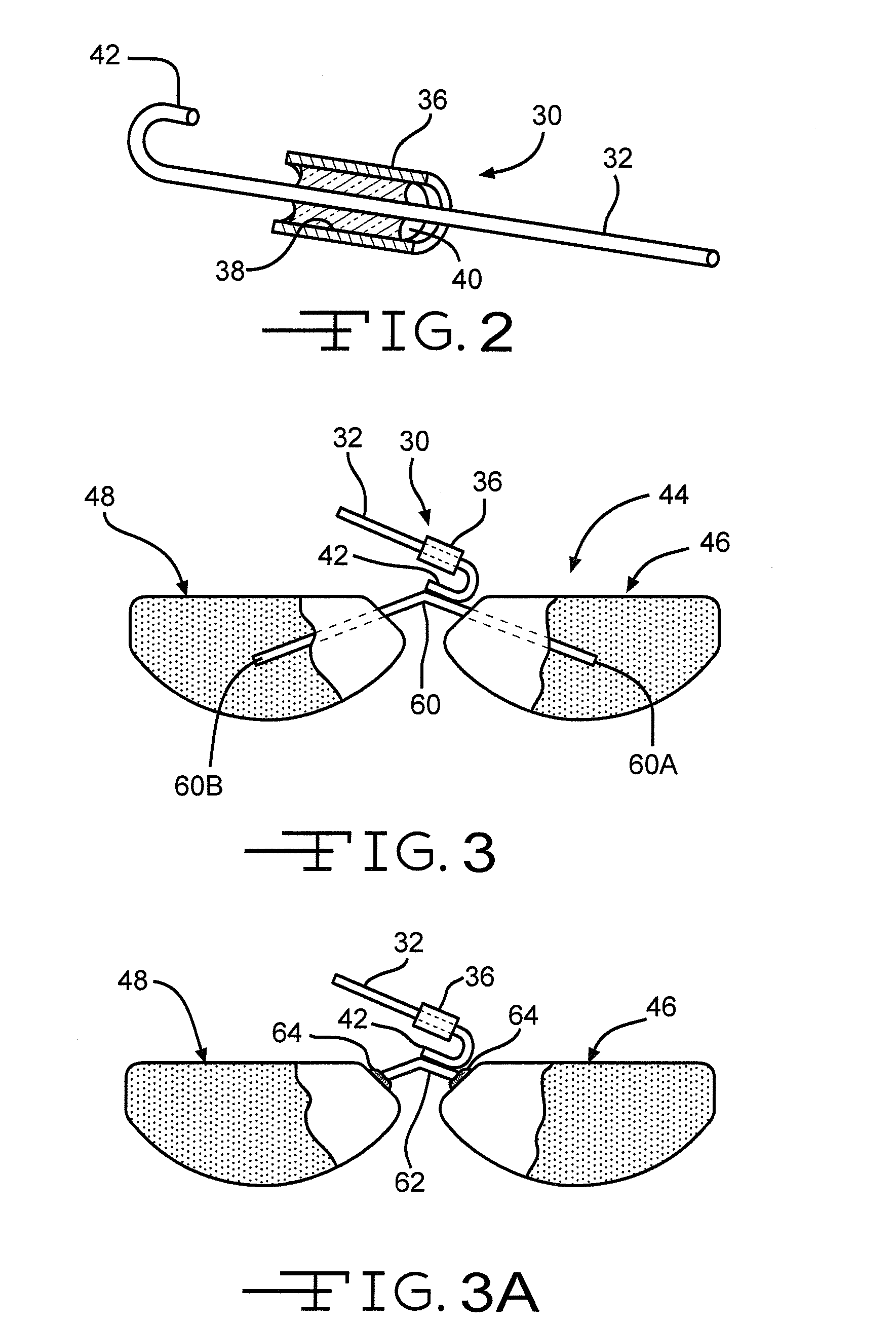 Dual anode capacitor with internally connected anodes