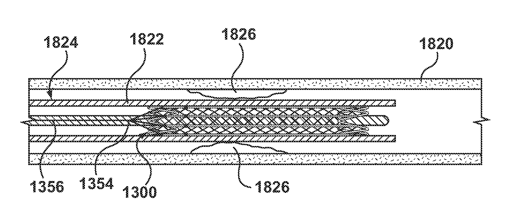 Biodegradable Stent Having Non-Biodegradable End Portions and Mechanisms for Increased Stent Hoop Strength