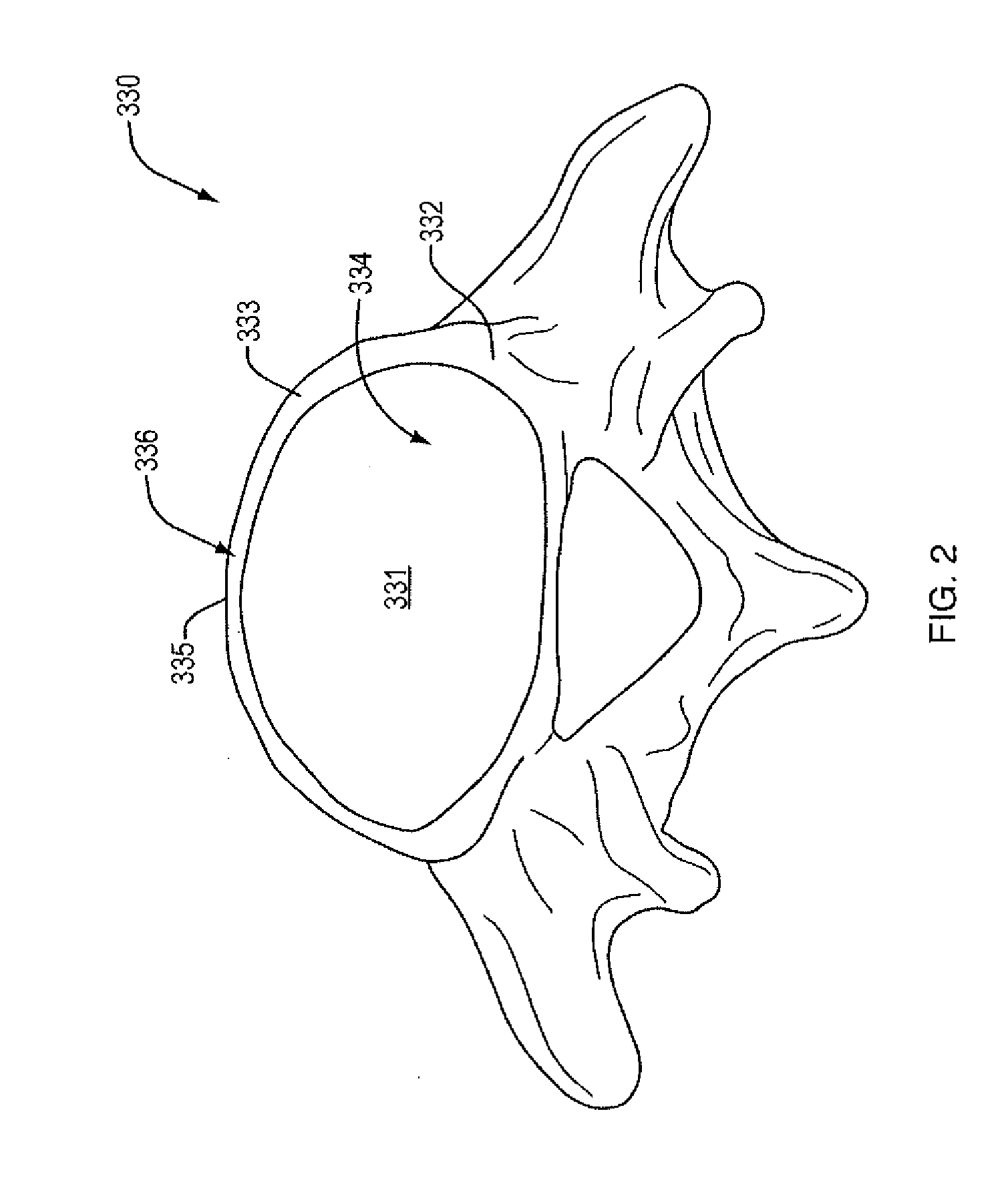 Expandable spinal implant apparatus and method of use