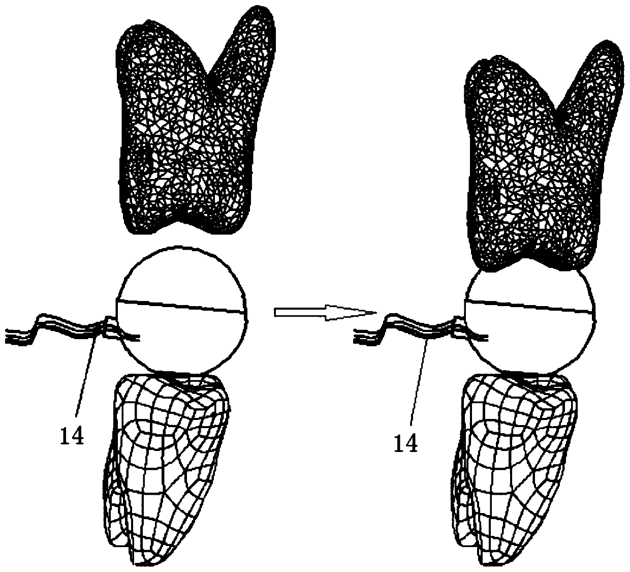 A multi-directional bite force measurement device based on force sensor