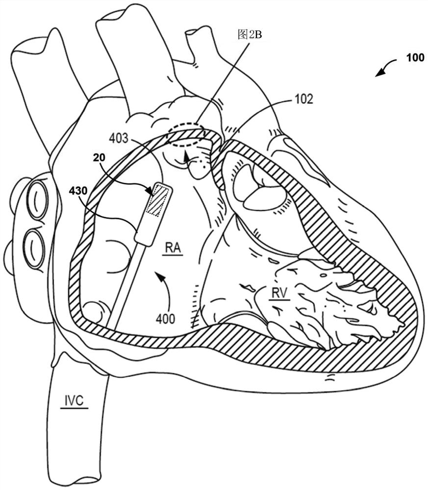 Fixation components for implantable medical devices