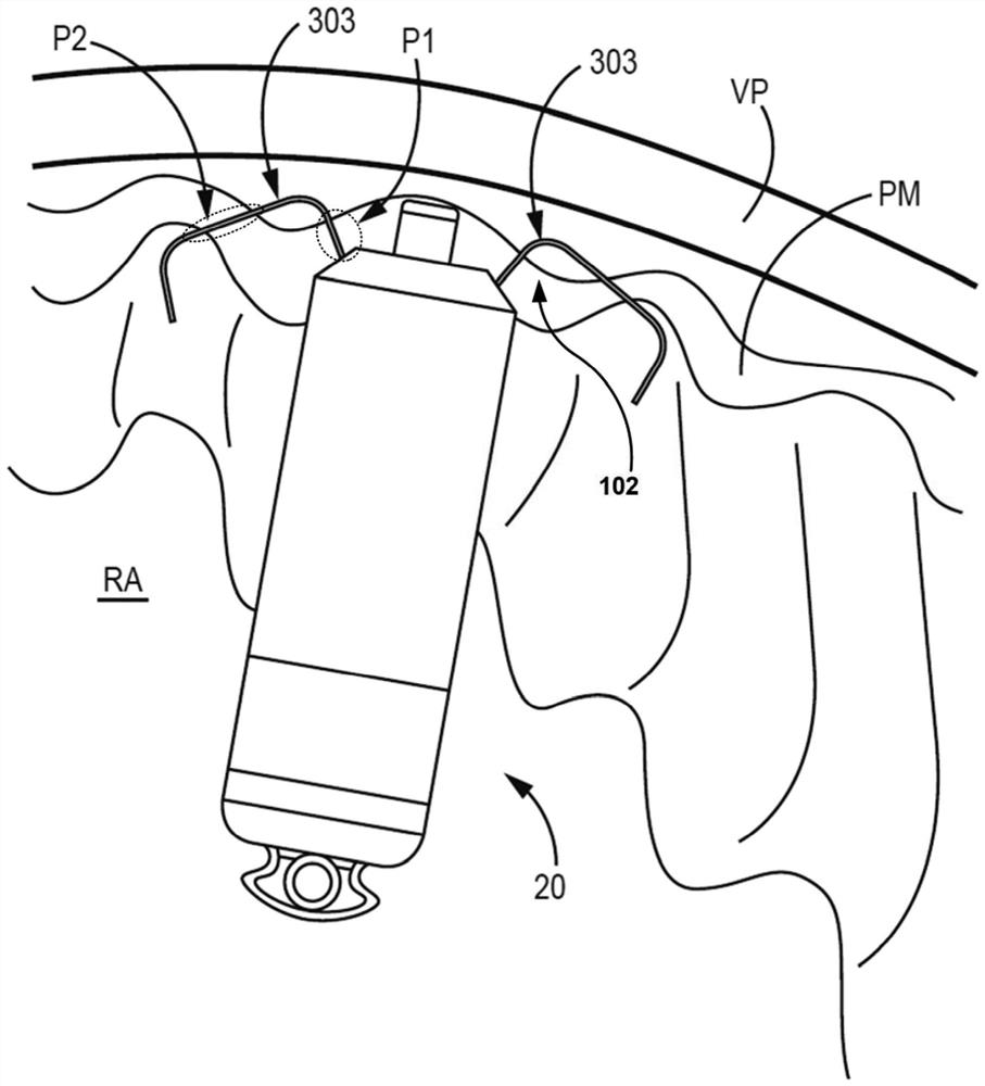 Fixation components for implantable medical devices