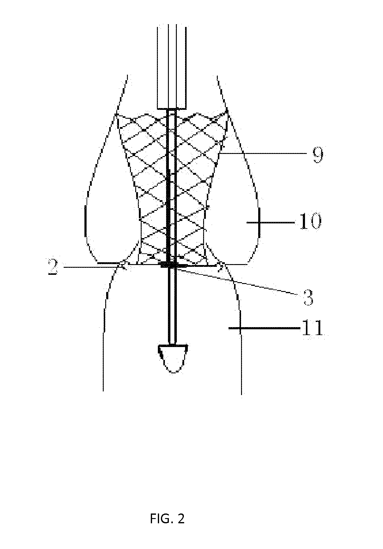 Conveying appliance with valve locating function for use during percutaneous aortic valve replacement operation