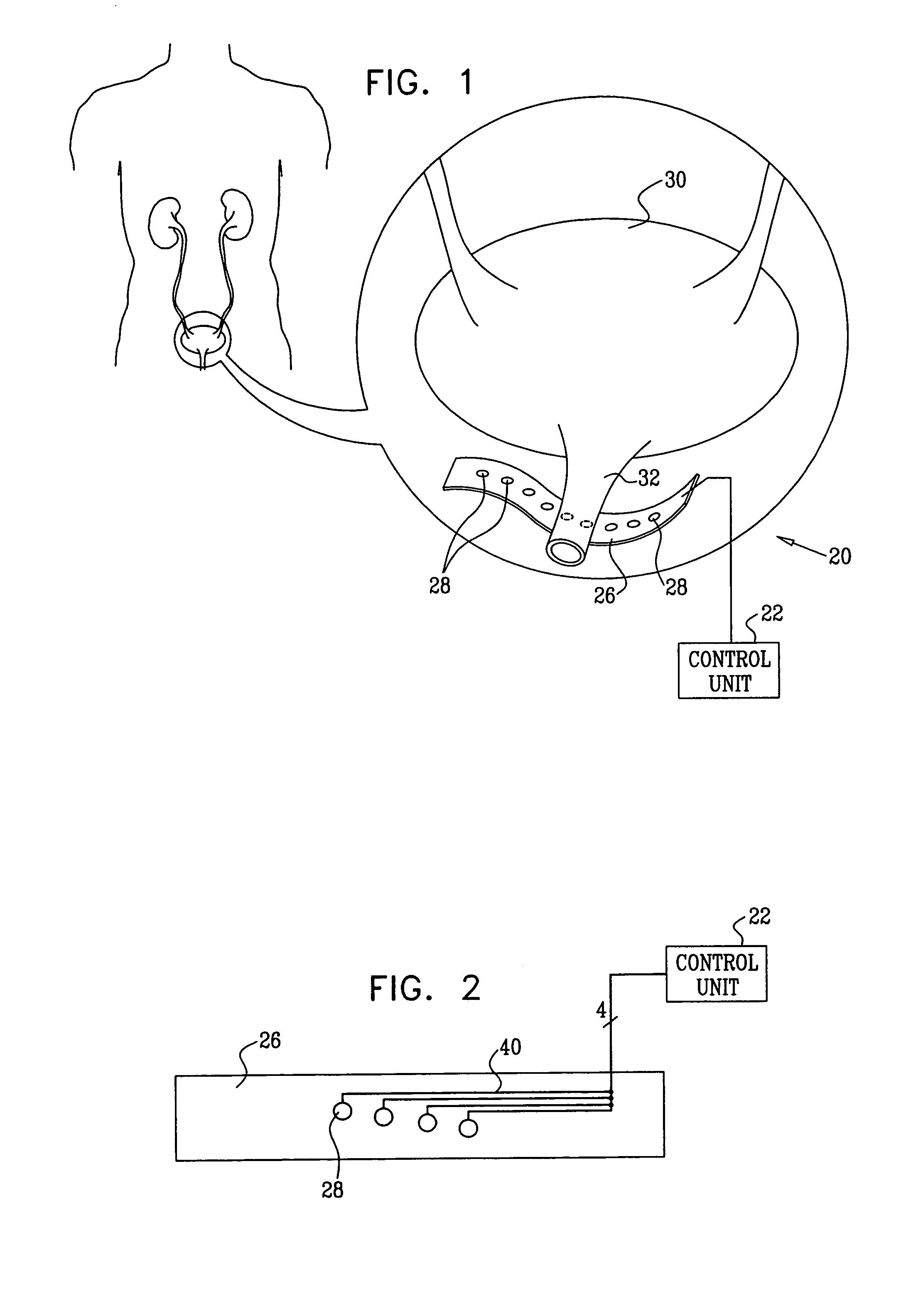Apparatus for treating stress and urge incontinence