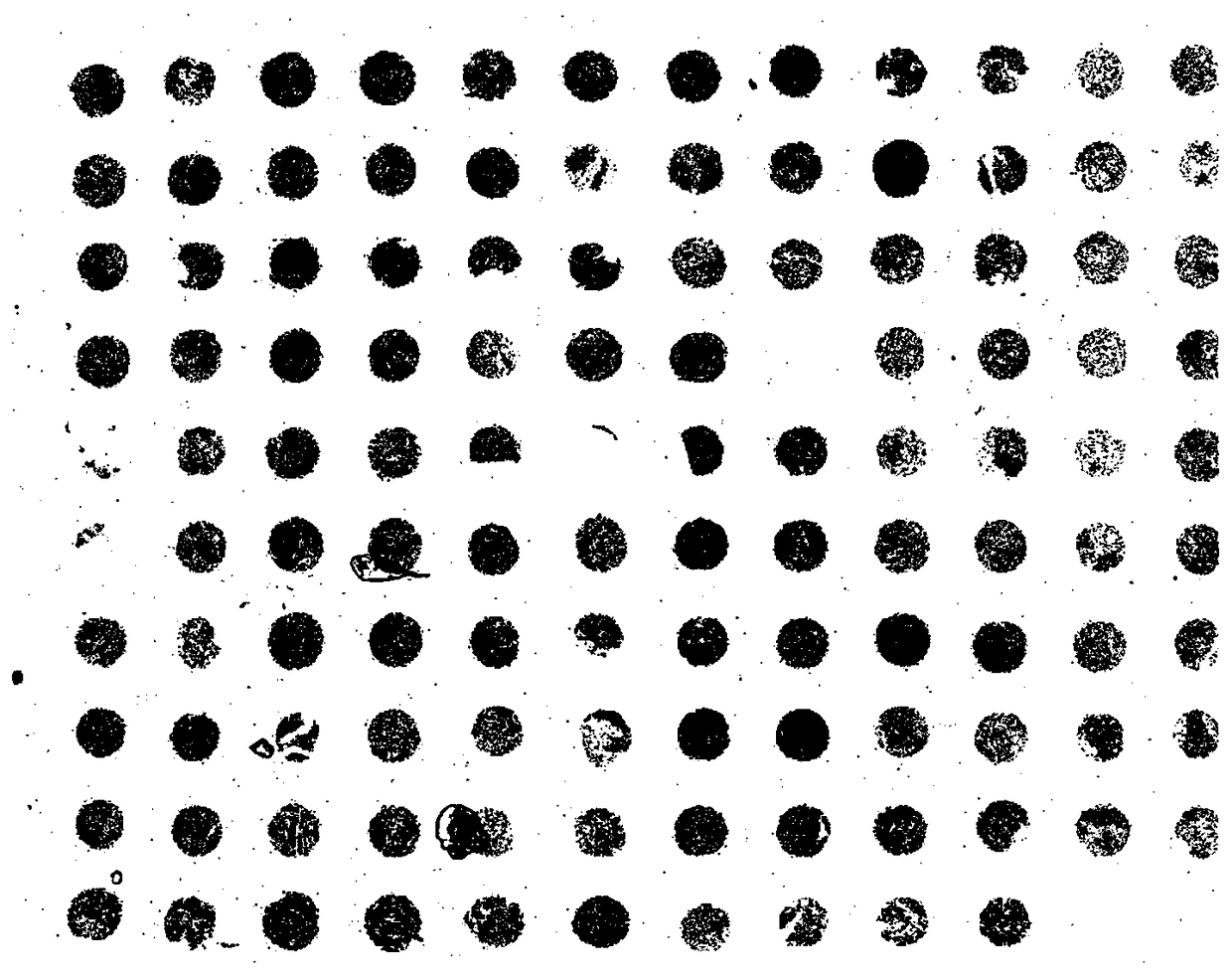 An automatic segmentation method for microarray images of tumor tissue