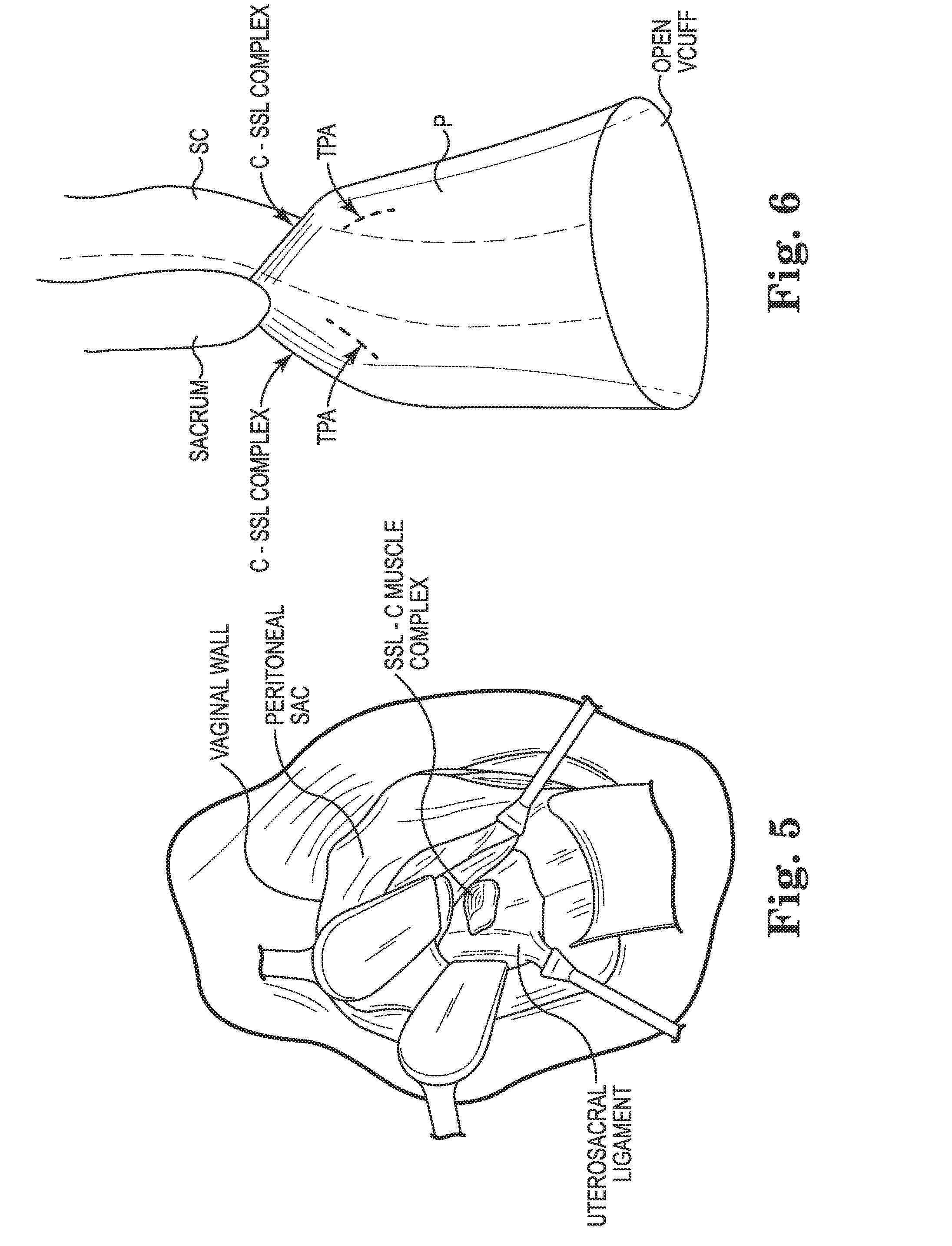 Transperitoneal prolapse repair system and method