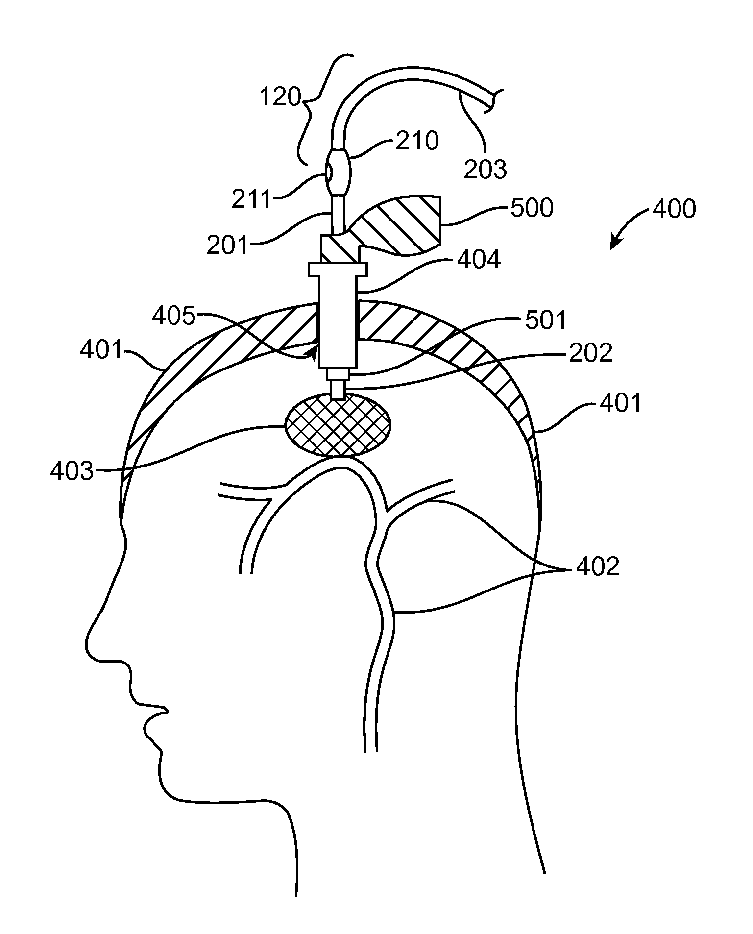 Methods and Devices for Removing Obstructing Material From the Human Body
