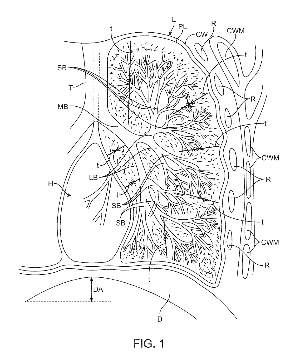 Devices, treatments and methods to restore tissue elastic recoil
