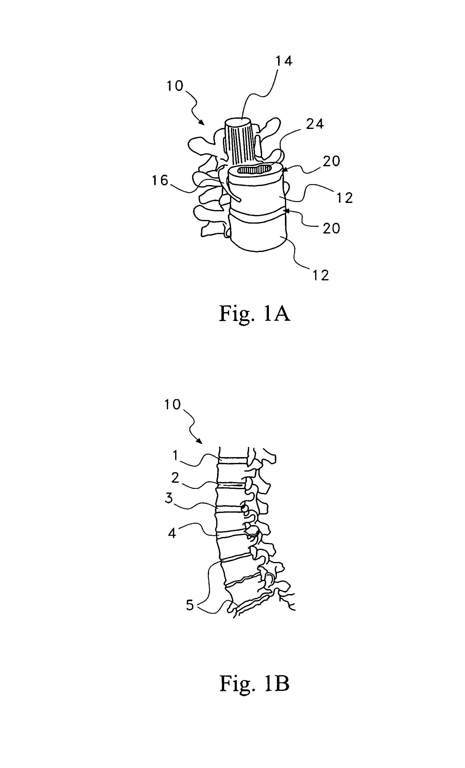 Pharmaceutical removal of neuronal extensions from a degenerating disc