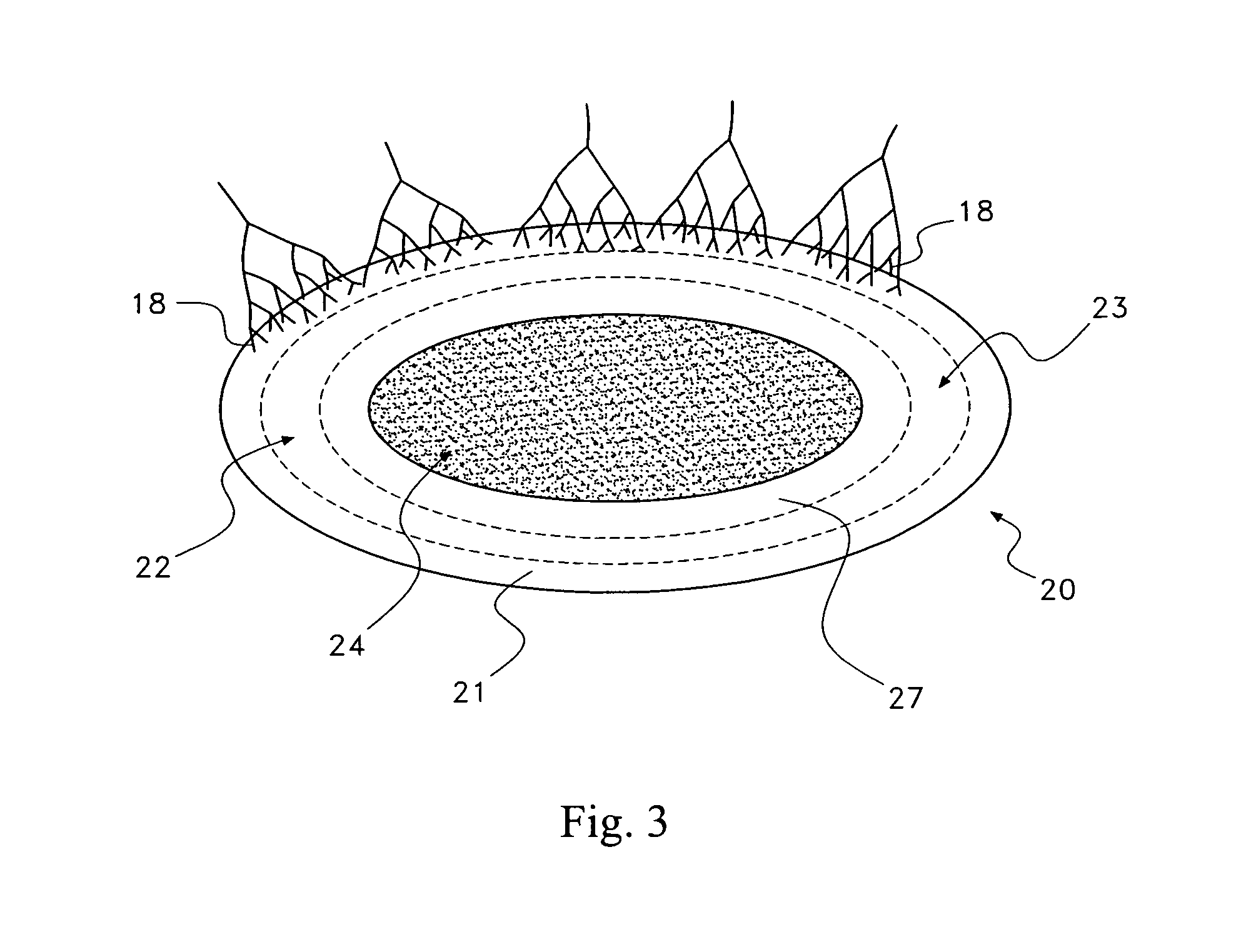 Pharmaceutical removal of neuronal extensions from a degenerating disc
