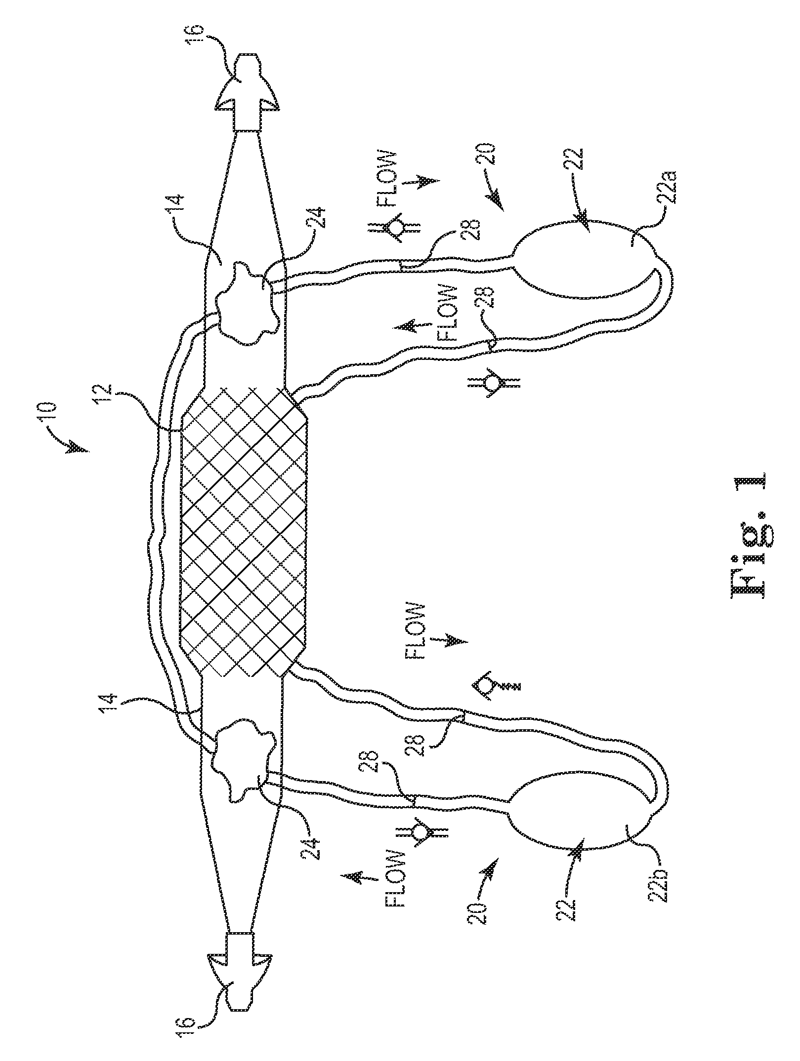 Implant tension adjustment system and method