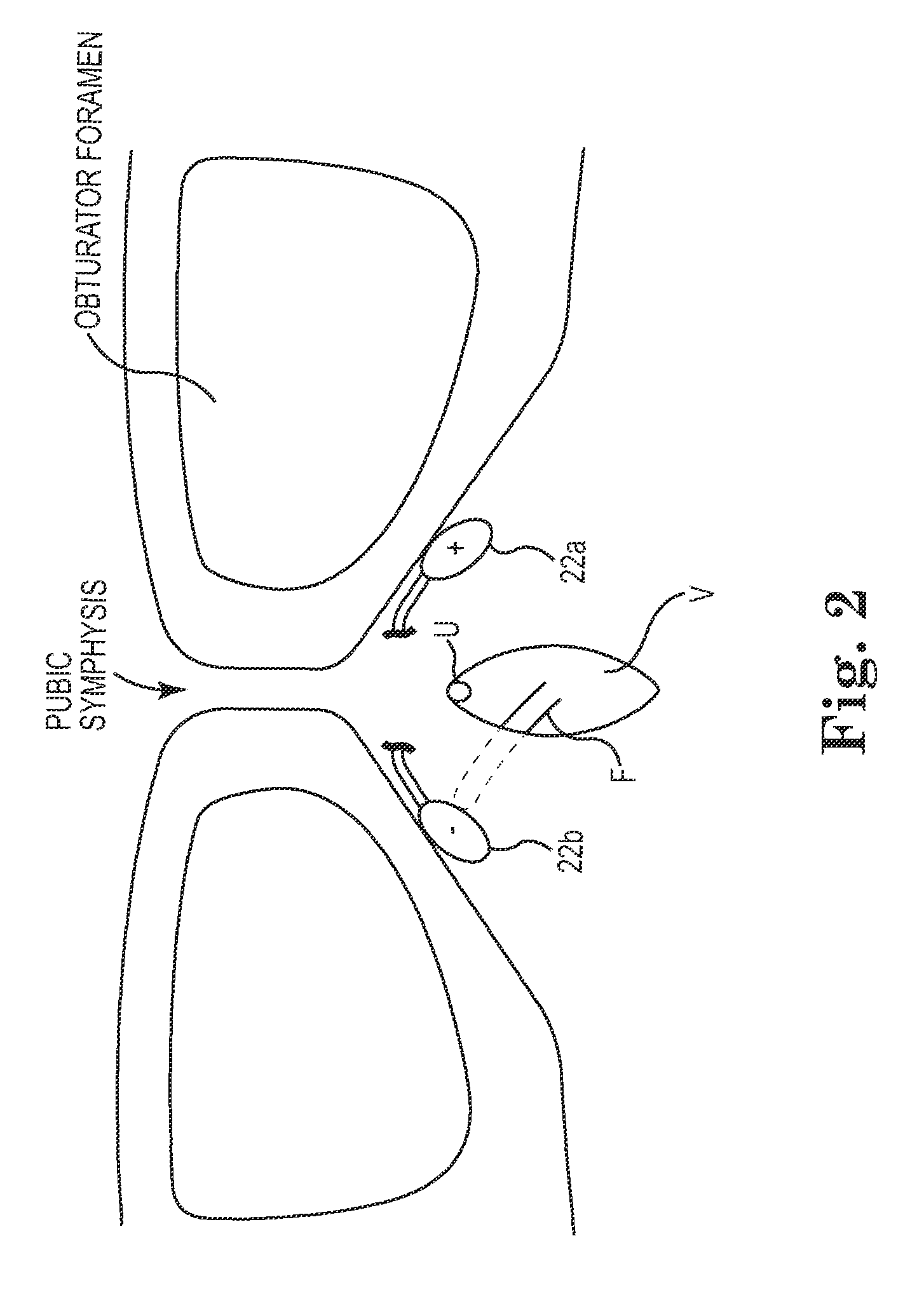 Implant tension adjustment system and method