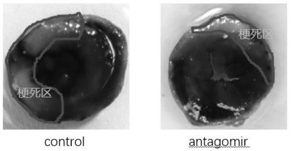 Application of miR-208a-3p antisense nucleic acid in treatment of myocardial ischemia reperfusion injury