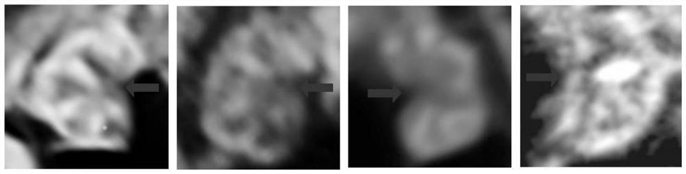 Segmentation method for cerebellar earthworm part in ultrasonic image