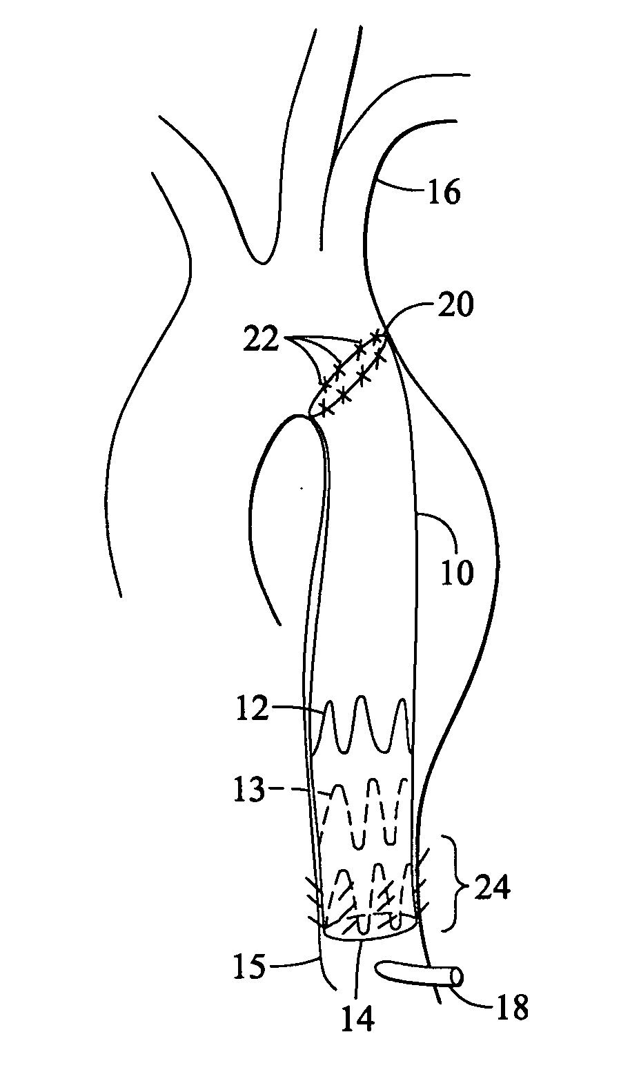 Tapered and distally stented elephant trunk stent graft