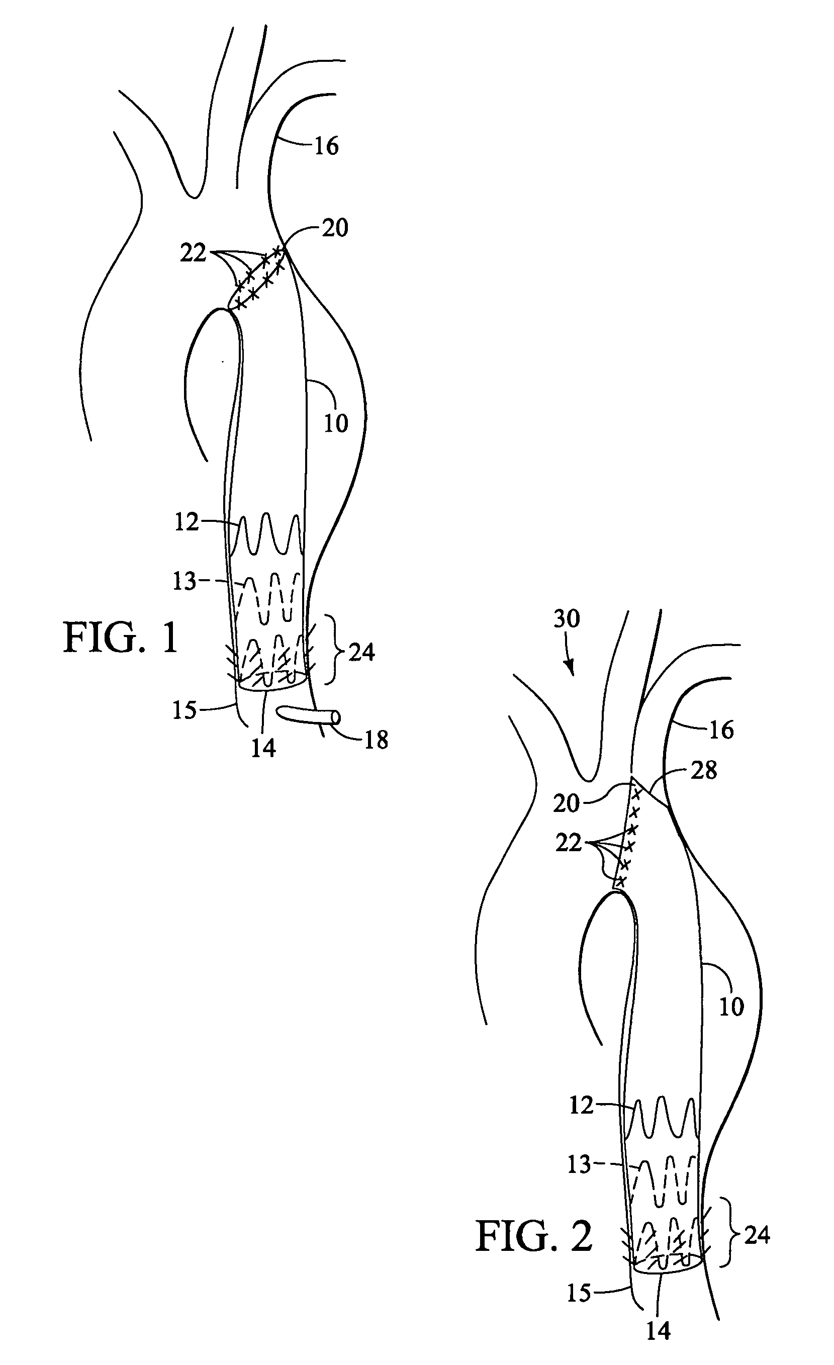 Tapered and distally stented elephant trunk stent graft