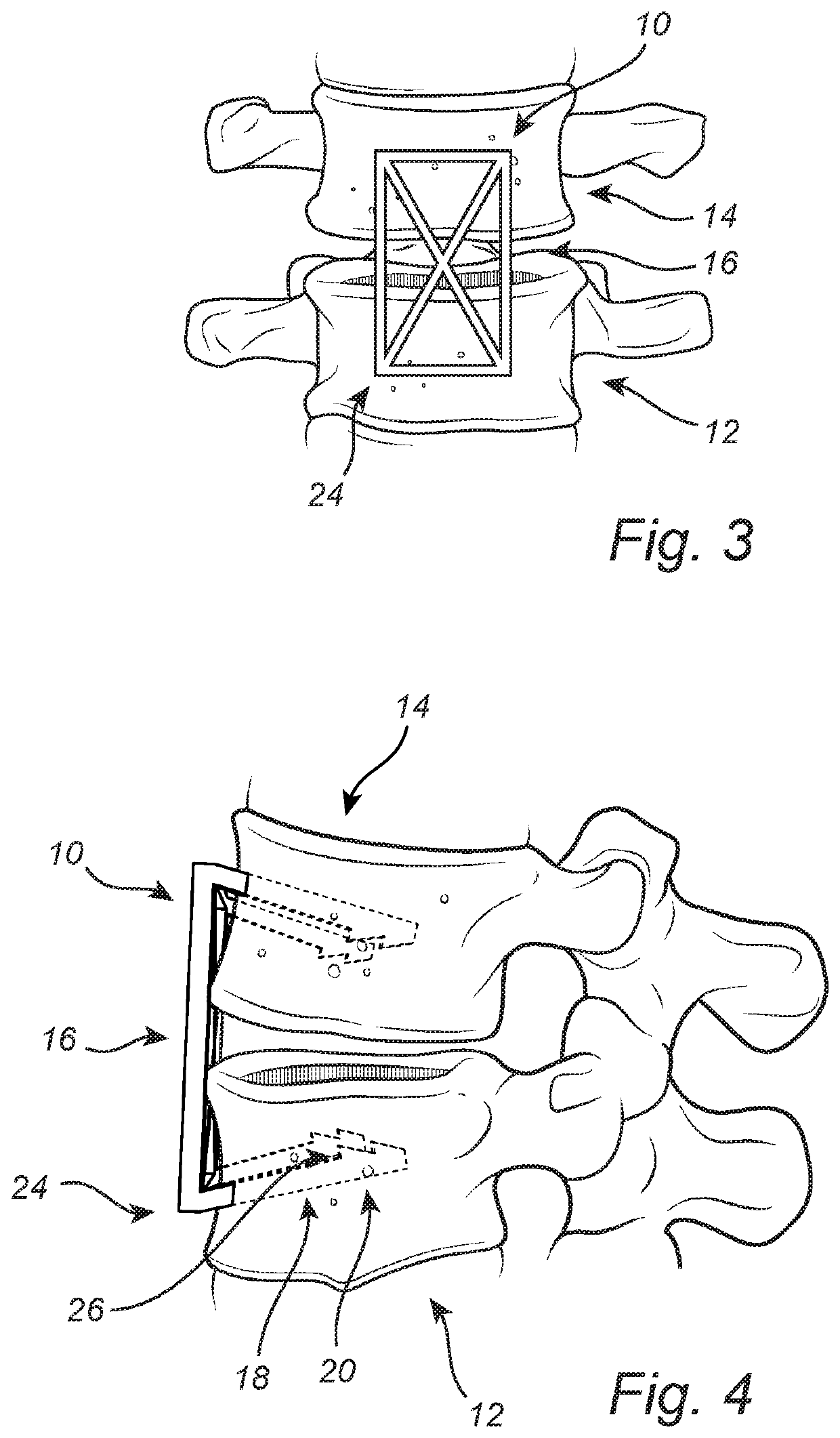 Continuous compression fixation device for the fusion of an intercalary structural augment