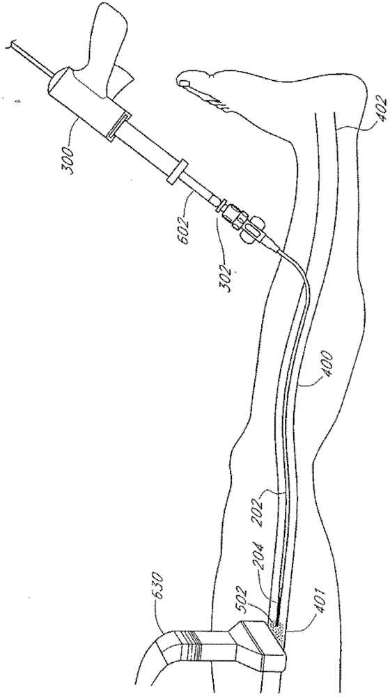 Method and device for treating venous occlusion in venous insufficiency
