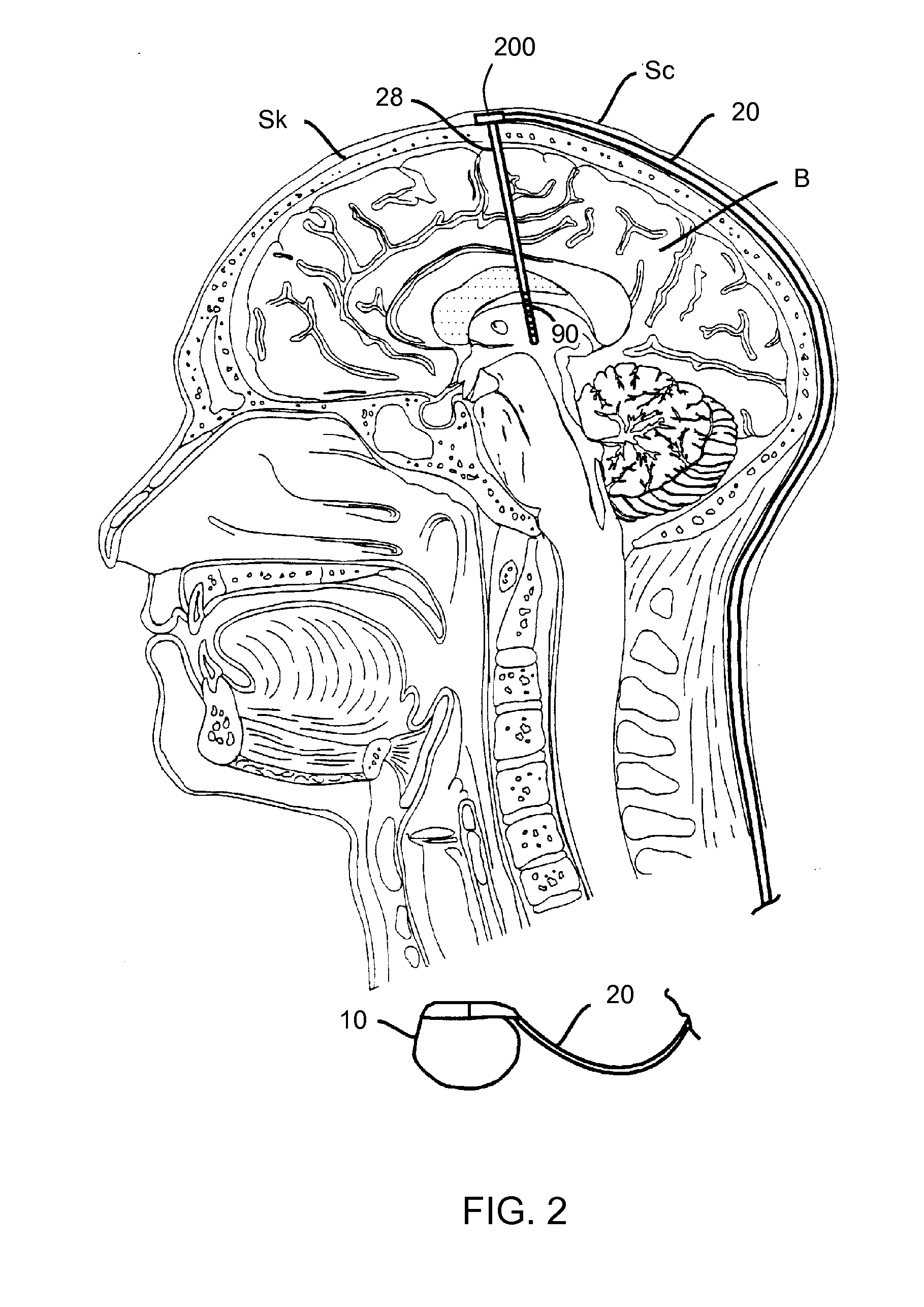 Lead having thin distal end portion