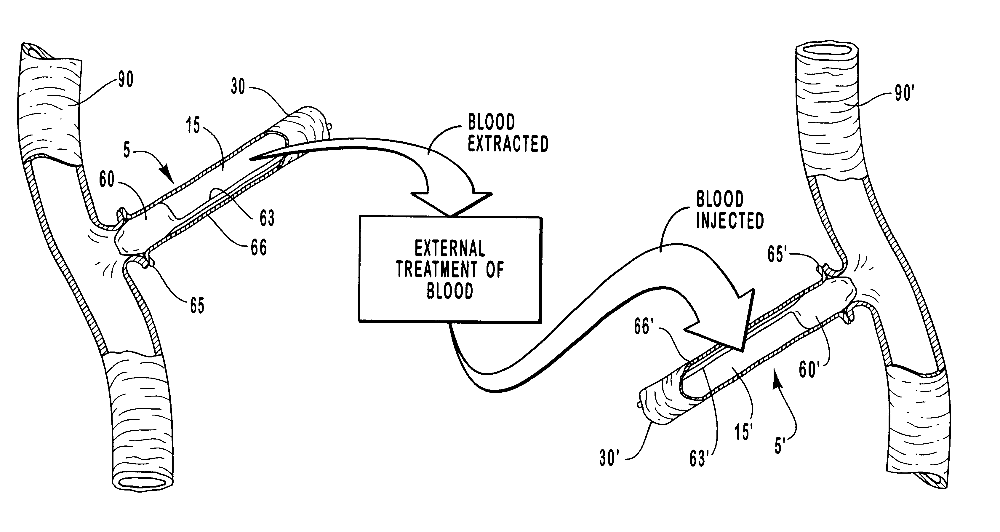 Methods for external treatment of blood