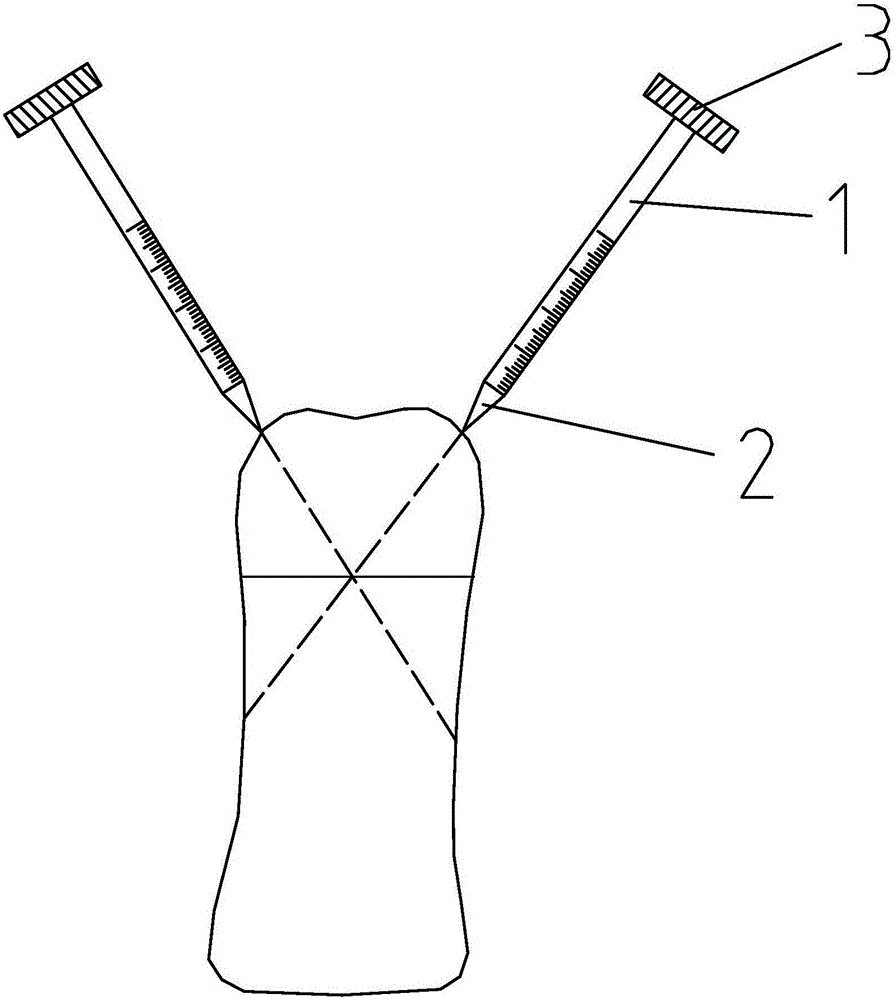 Hand twisting Kirschner wire for phalanges of children
