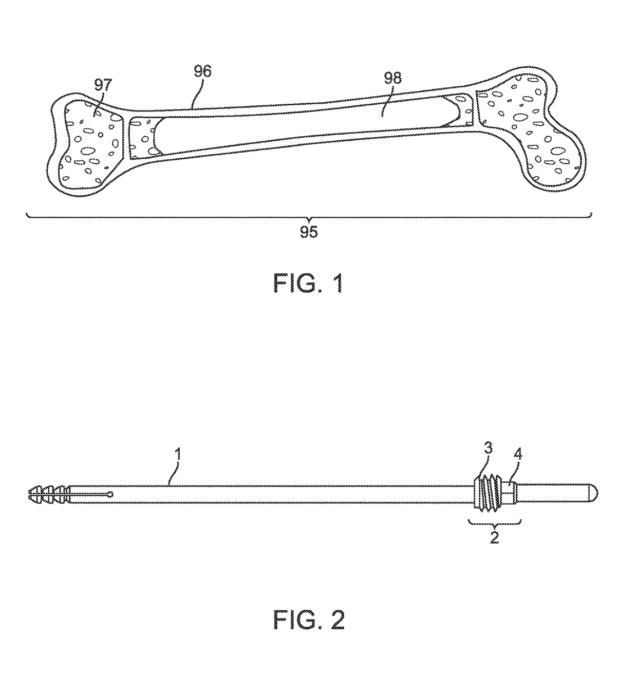 Implant and method for long bone fixation