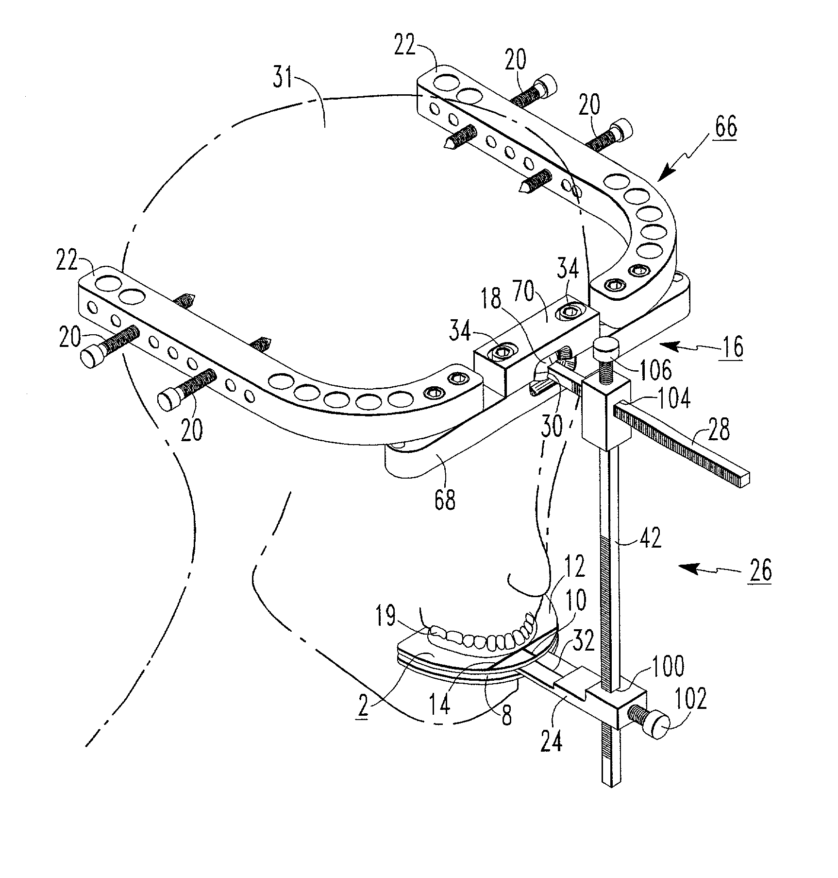 Method and apparatus to assist in orthognathic surgery