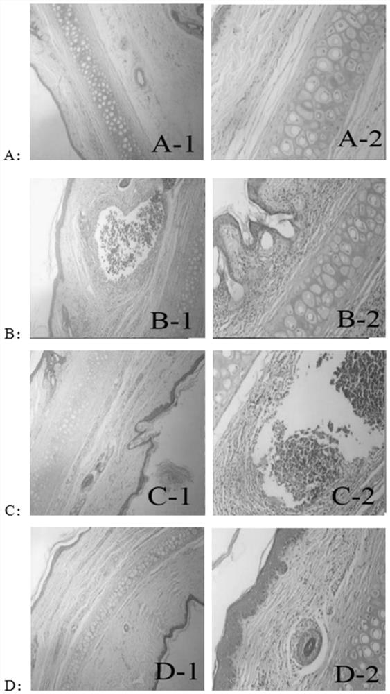 Application of atractylodes in the preparation of inhibitors of Propionibacterium acnes