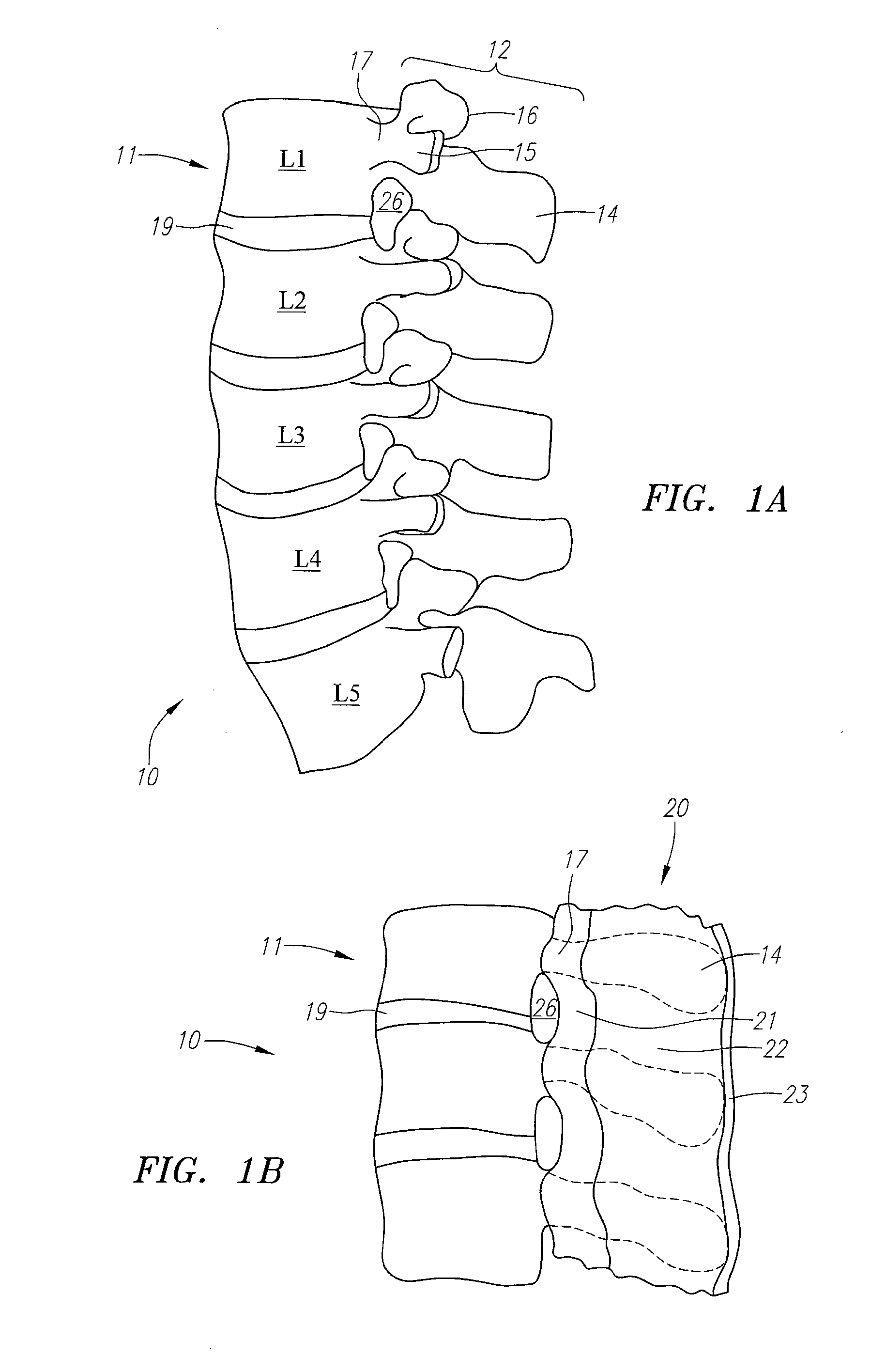 Spacer Devices and Systems for the Treatment of Spinal Stenosis and Methods for Using the Same