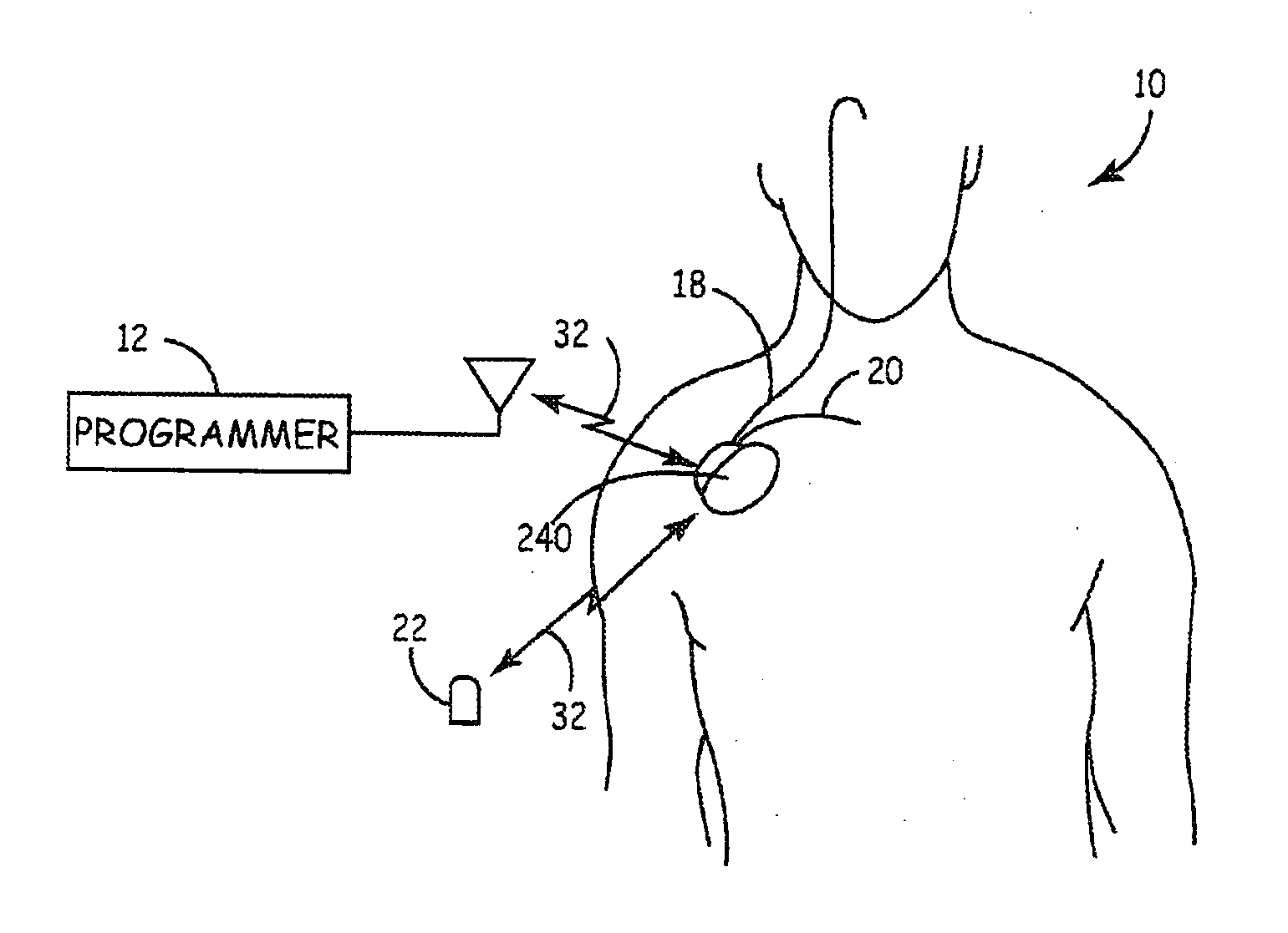 System and method for segmenting a cardiac signal based on brain stimulation