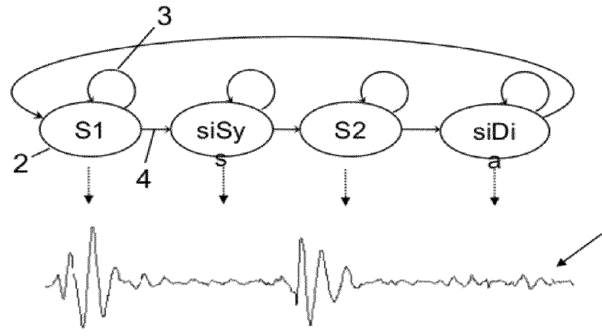 Segmenting a cardiac acoustic signal
