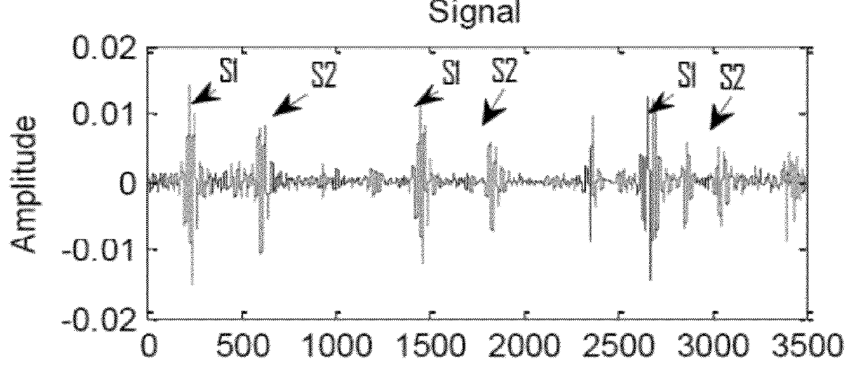 Segmenting a cardiac acoustic signal