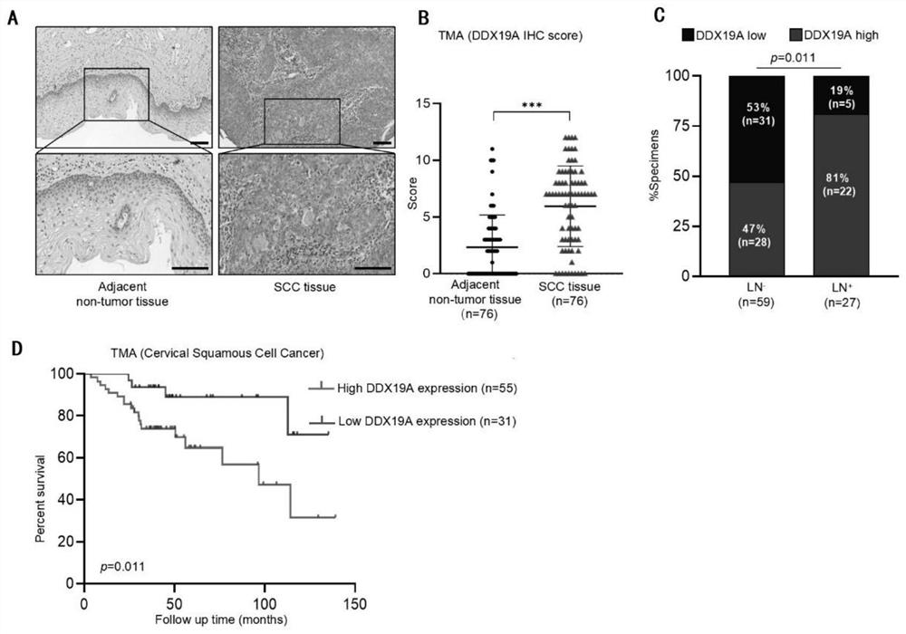 Application to promotion of cervical squamous cell carcinoma metastasis based on DDX19A