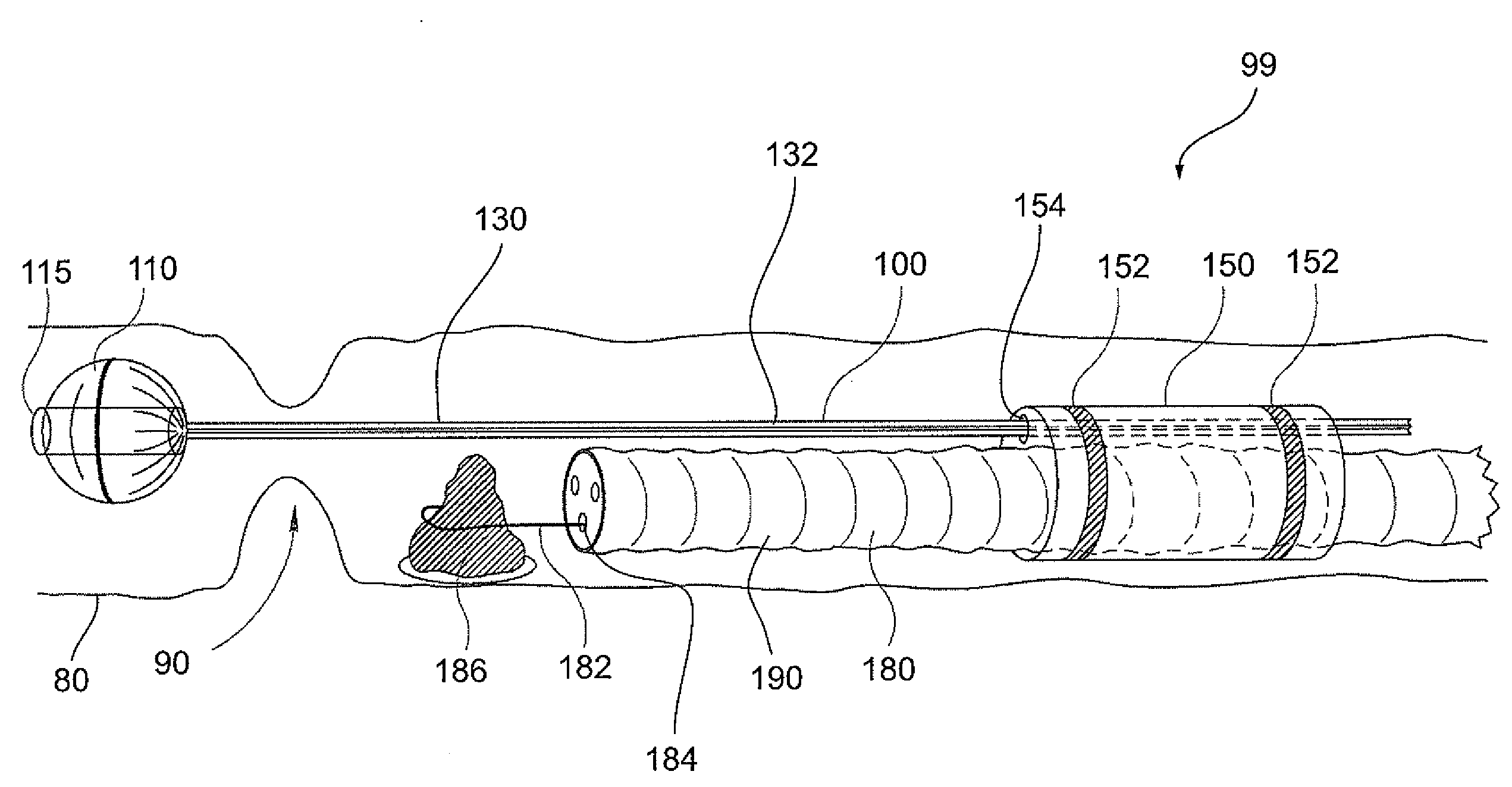 System and method for navigating a tool within a body conduit