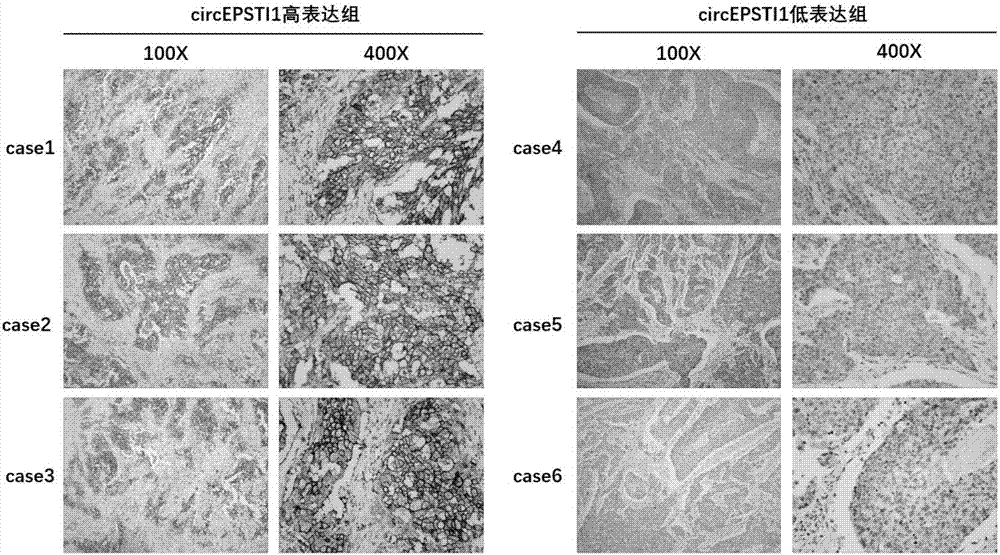 RNA (Ribonucleic Acid) circEPSTI1 (Epithelial-stromal Interaction 1) and application thereof in triple negative breast cancer