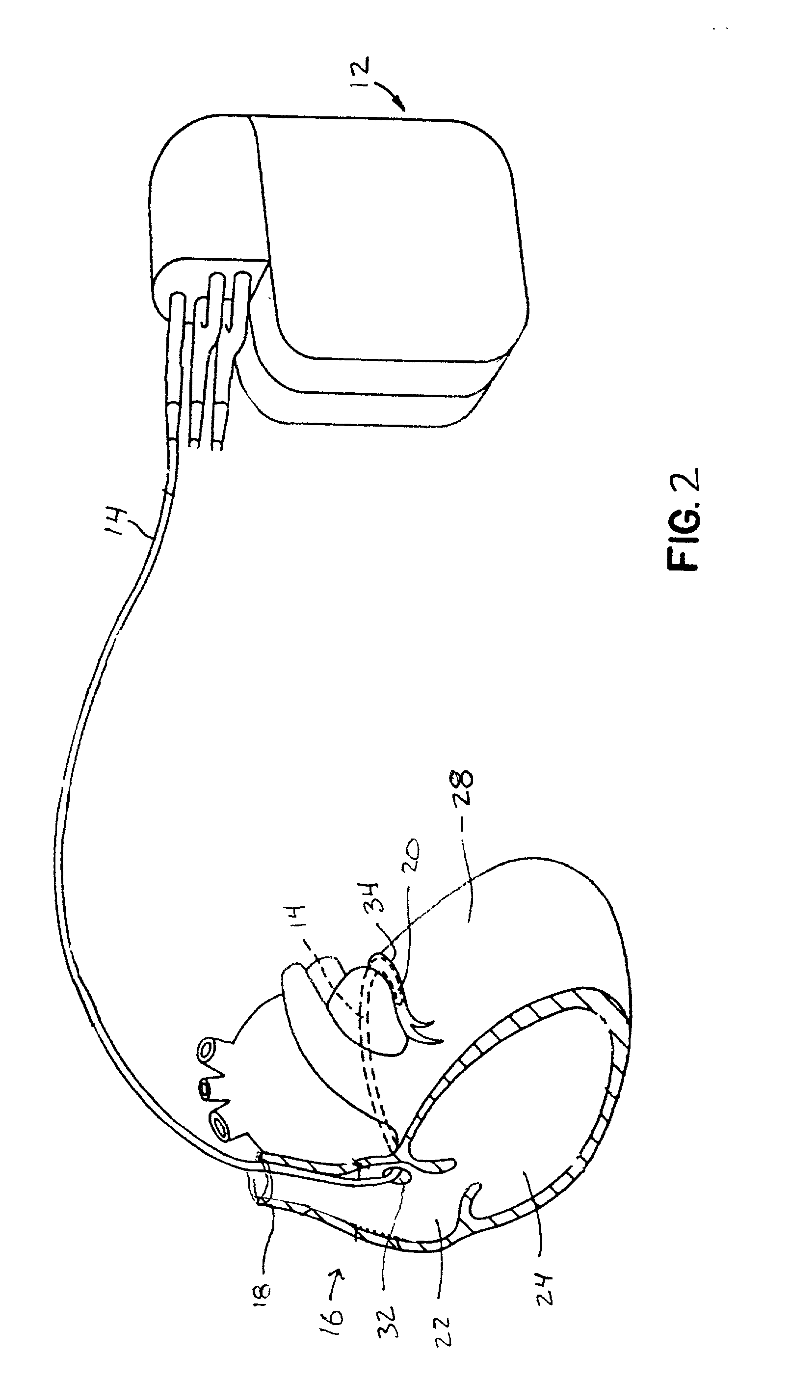 Method and apparatus for endovenous pacing lead