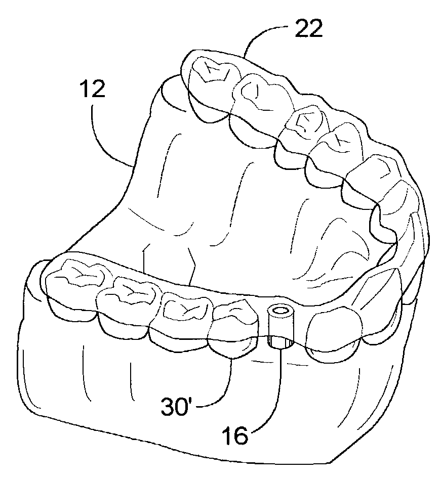 Method of installing a dental implant