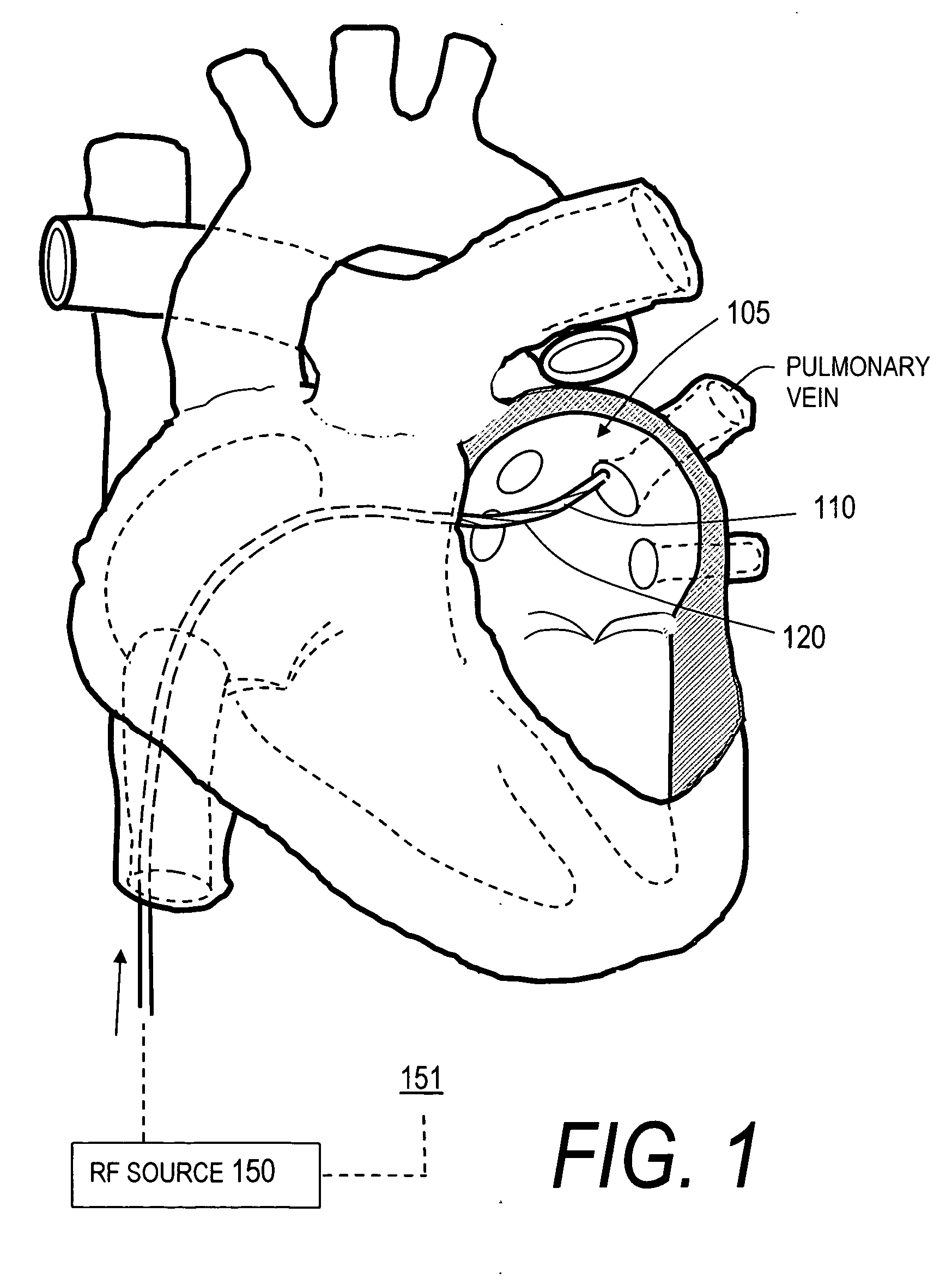 Endovascular catheter and method of use