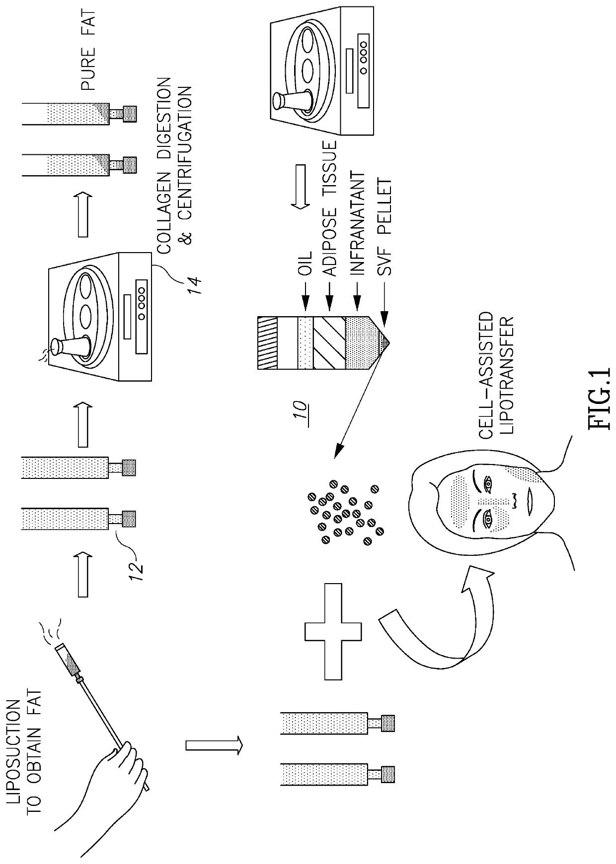 System and method for harvesting autologous adipose tissue