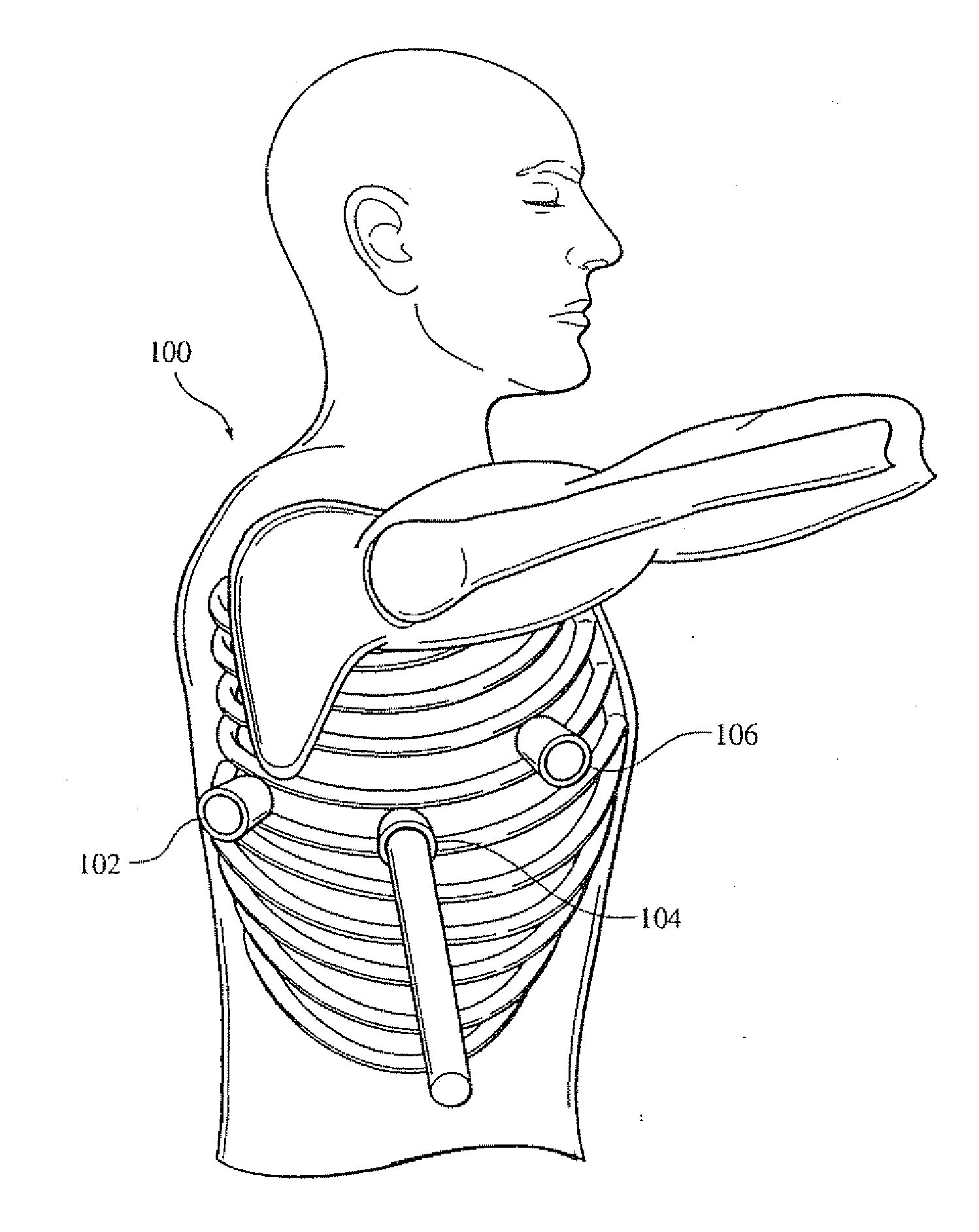 Electrical stimulation of the sympathetic nerve chain